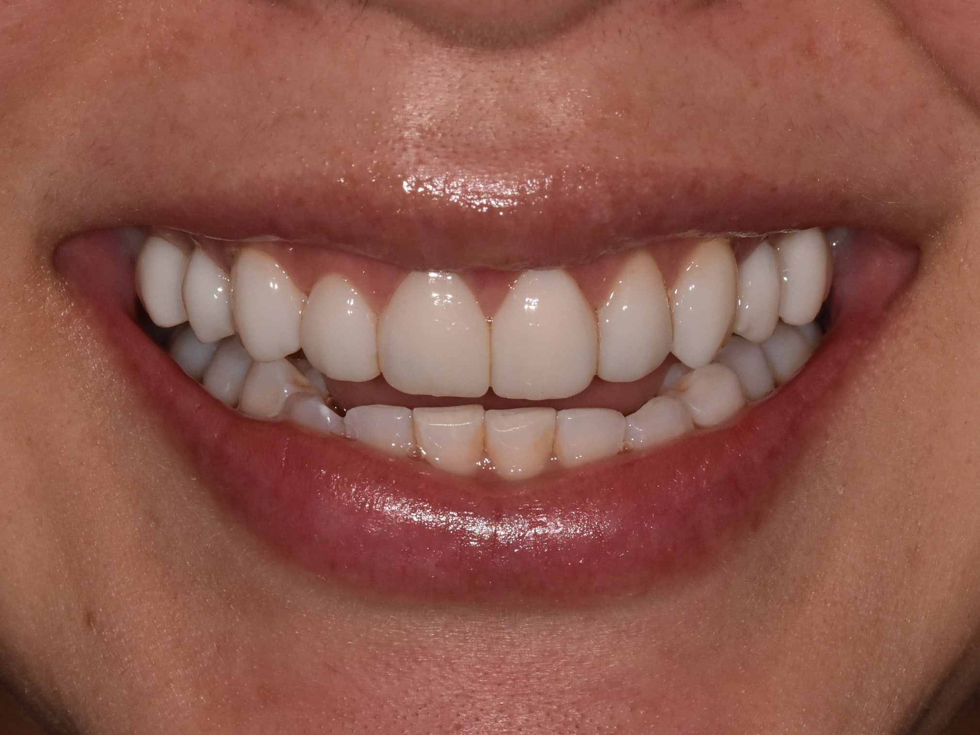 Gum contouring and composite bonding, after treatment, front view of smile