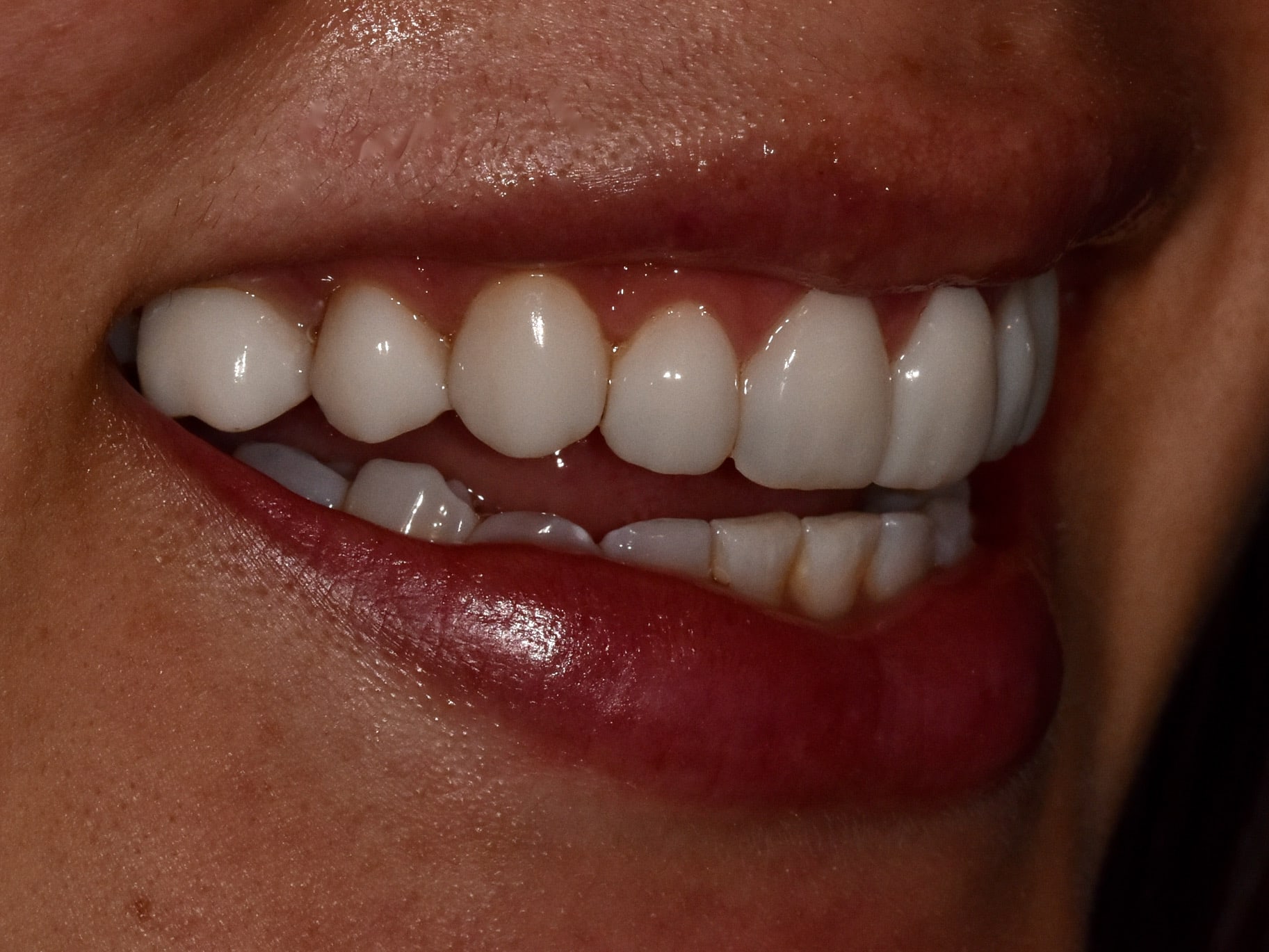Gum contouring and composite bonding, after treatment, left side view of smile