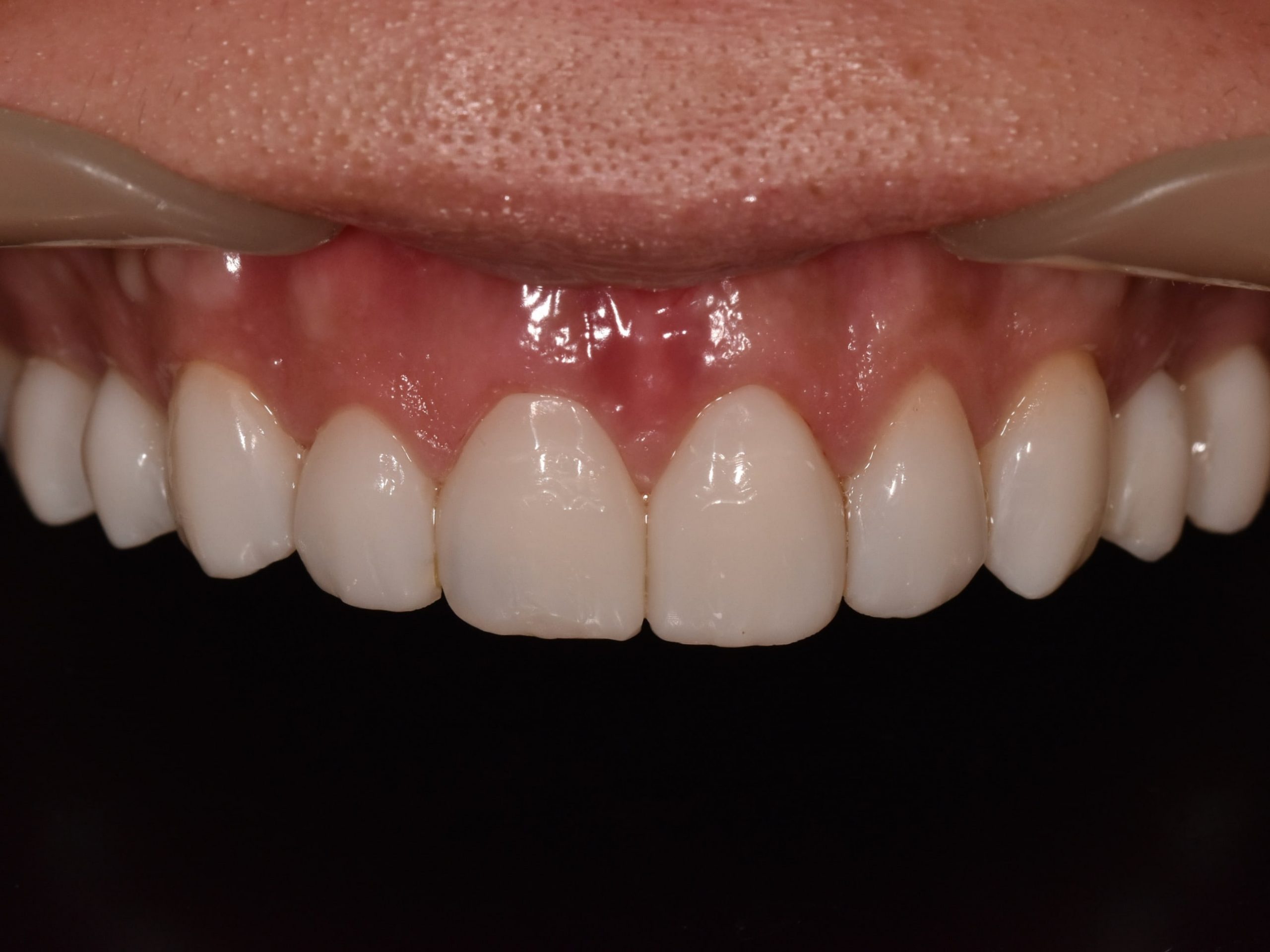 Gum contouring and composite bonding, after treatment, close-up of teeth and gums
