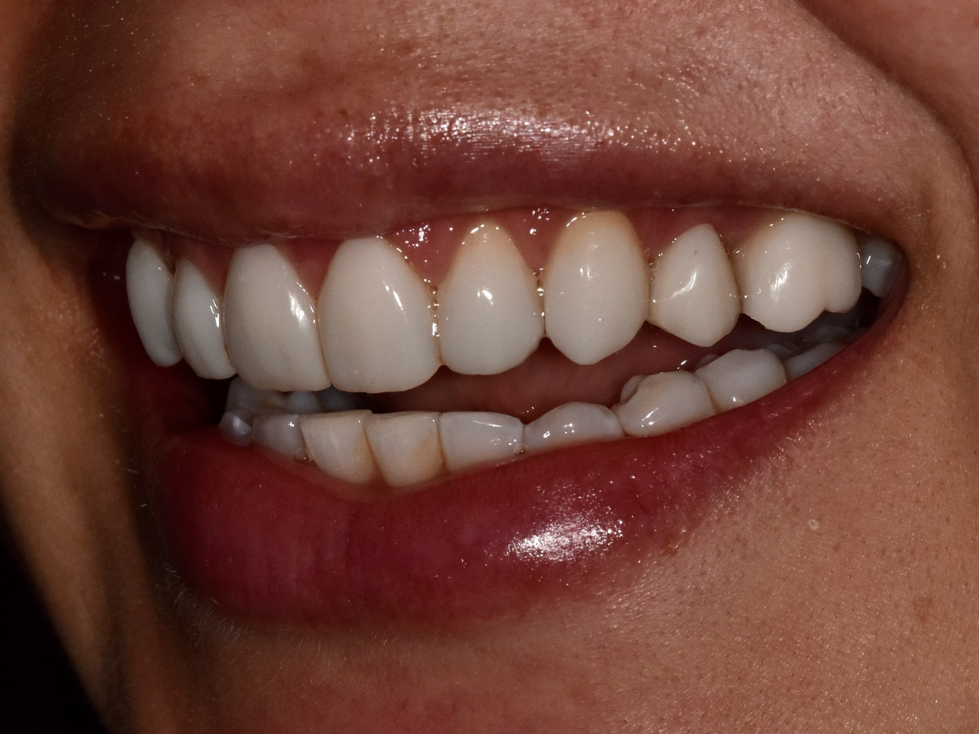 Gum contouring and composite bonding, after treatment, right side view of smile