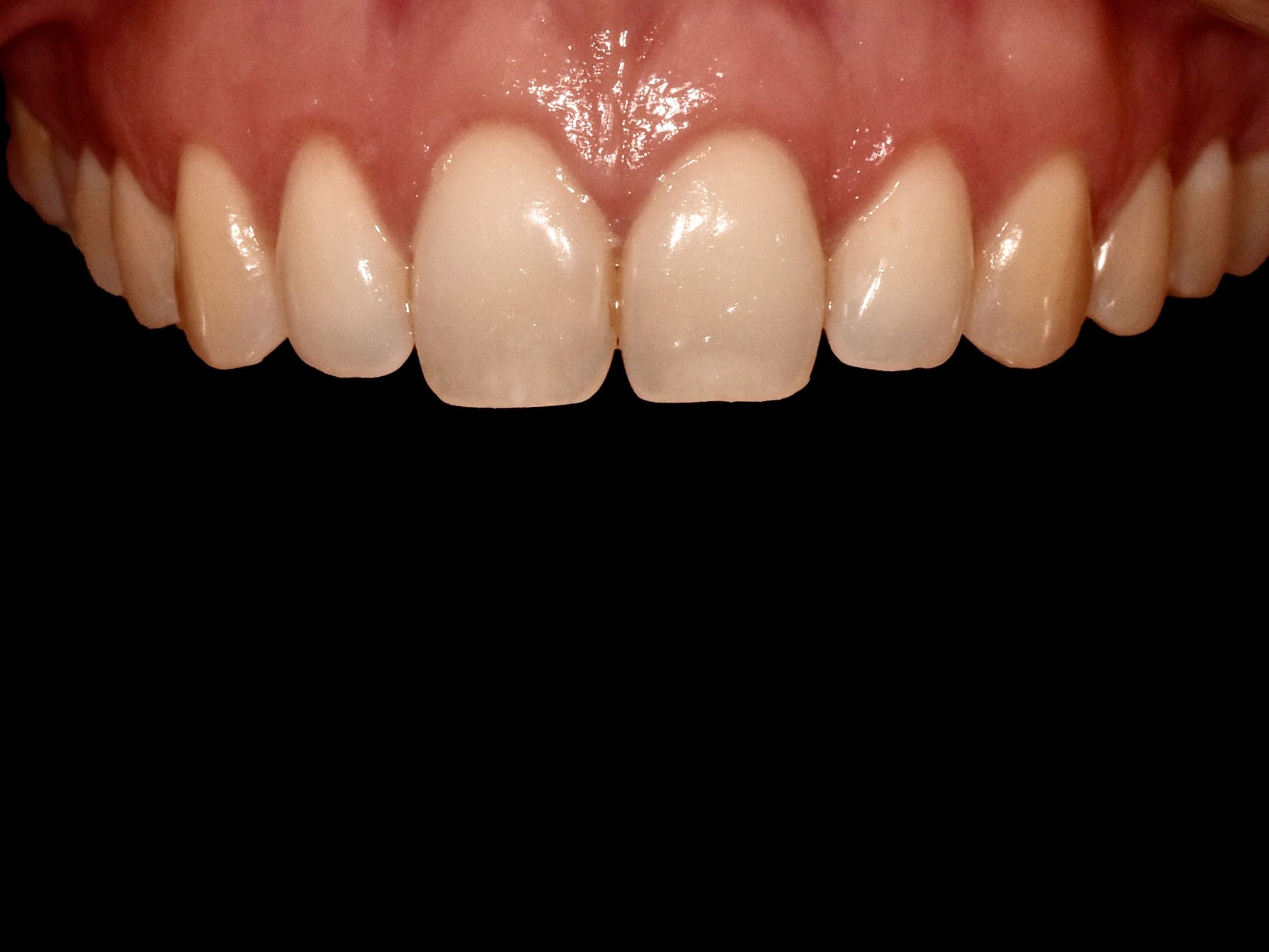 Gum contouring, after treatment, close-up of teeth and gums