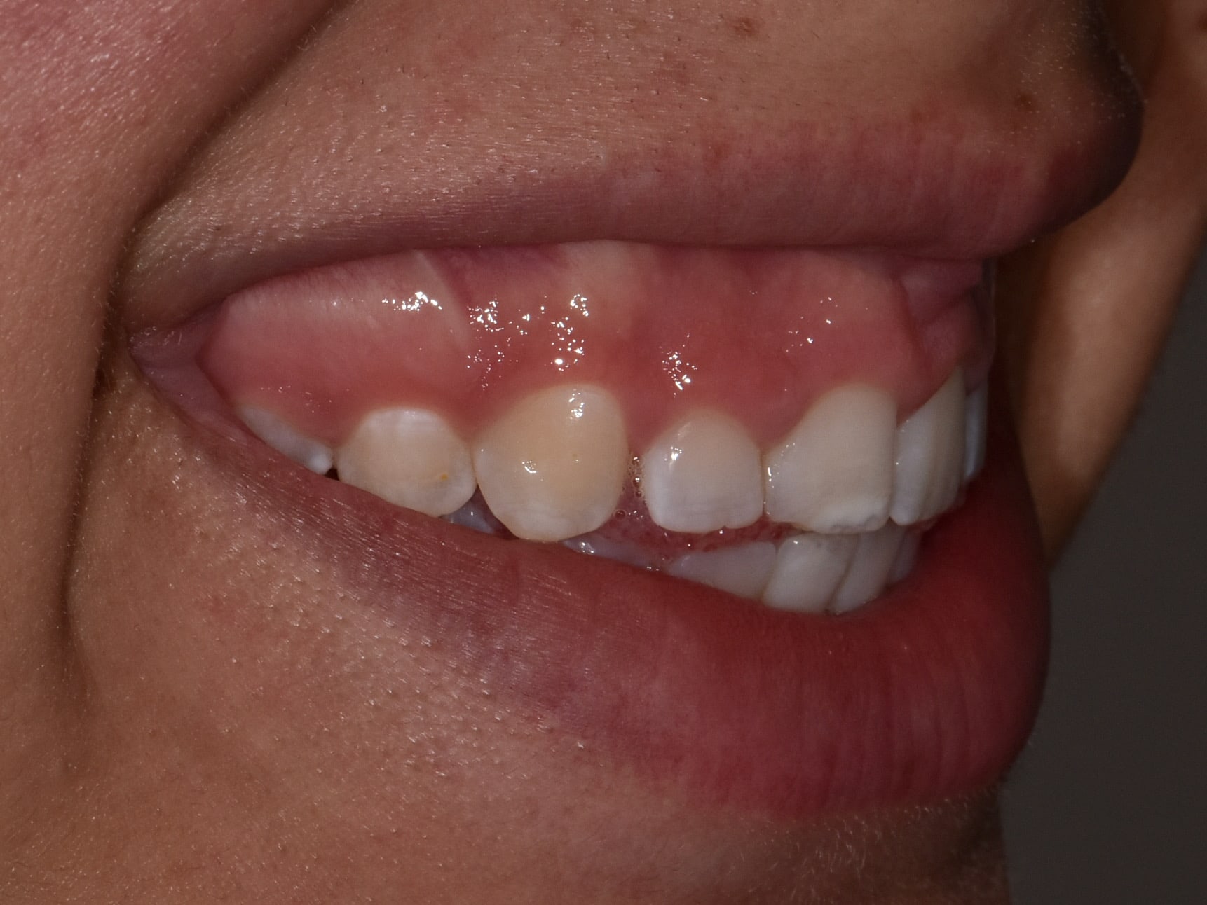Gum contouring and composite bonding, before treatment, left side view of smile