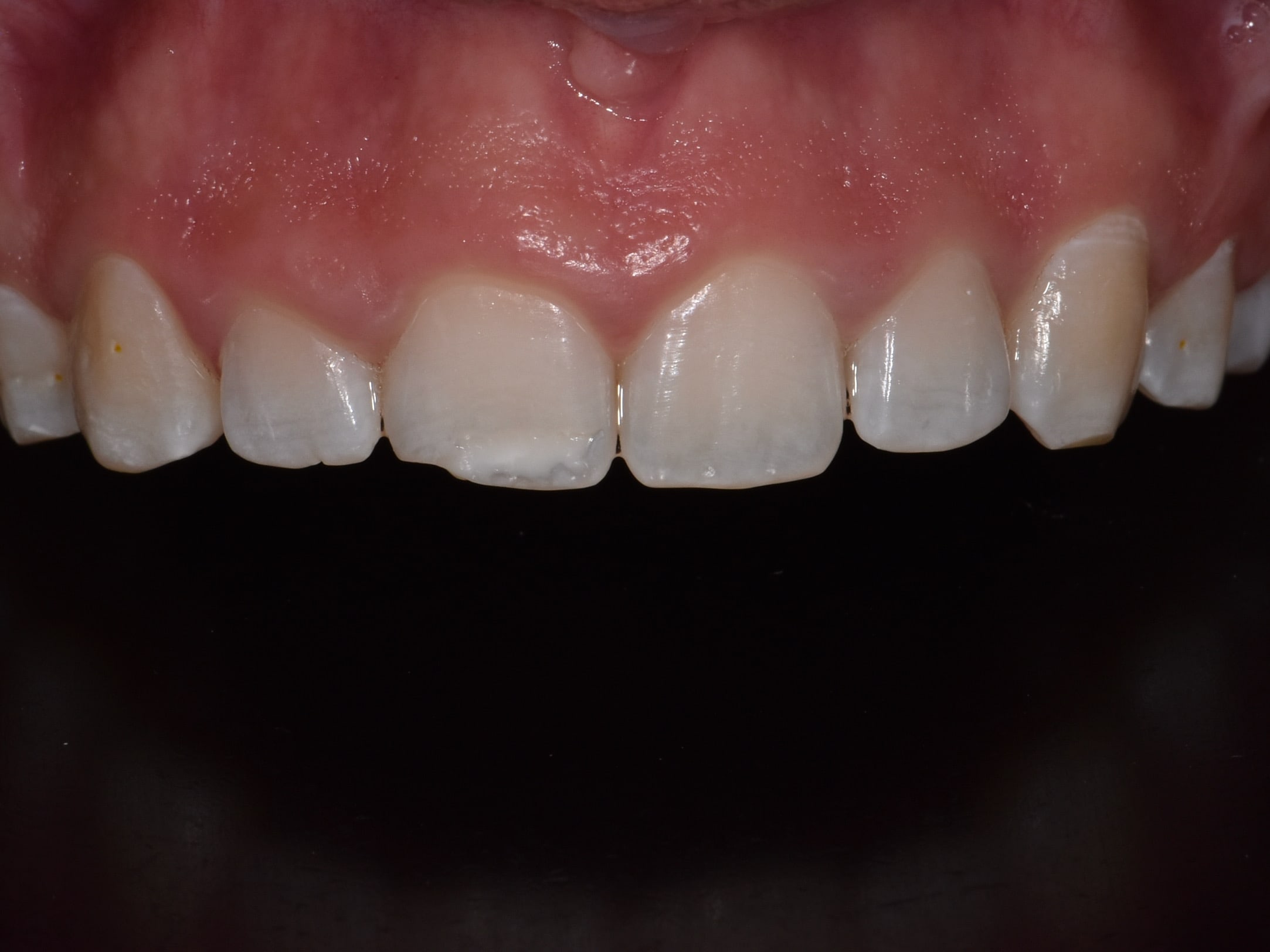Gum contouring and composite bonding, before treatment, close-up of teeth and gums