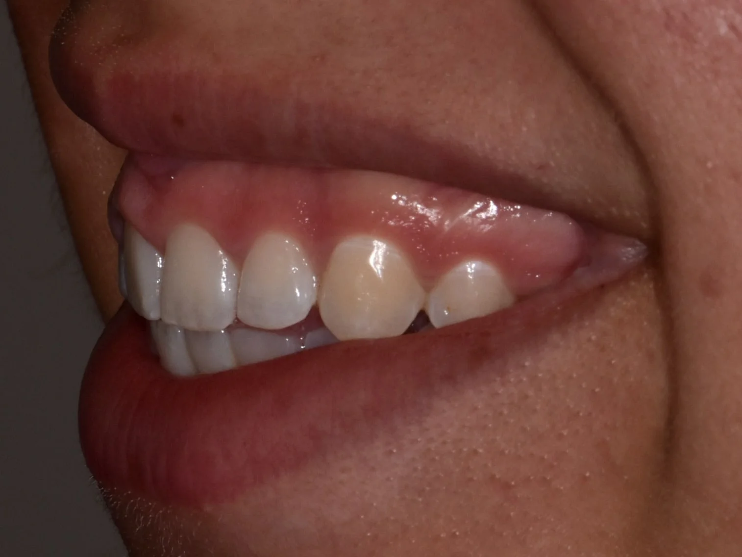 Gum contouring and composite bonding, before treatment, right side view of smile