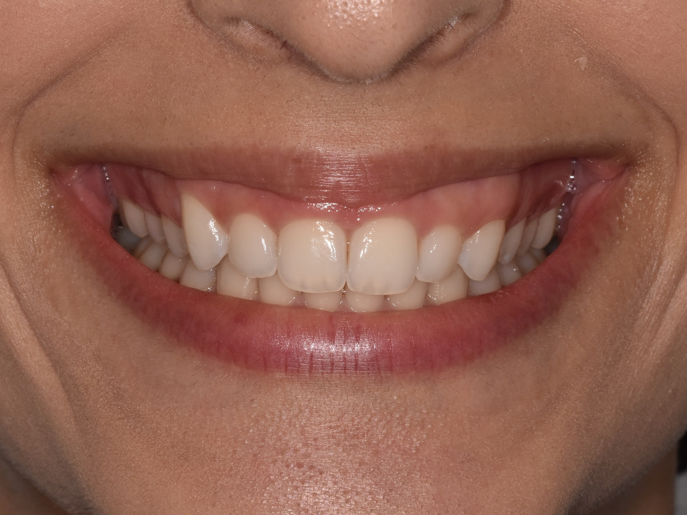 Gum contouring, before treatment, front view of smile