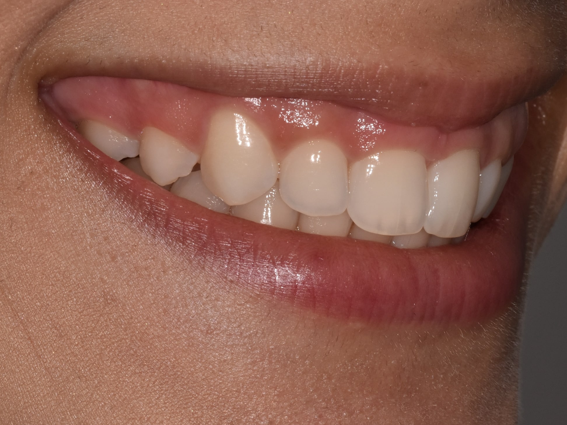 Gum contouring, before treatment, left side view of smile