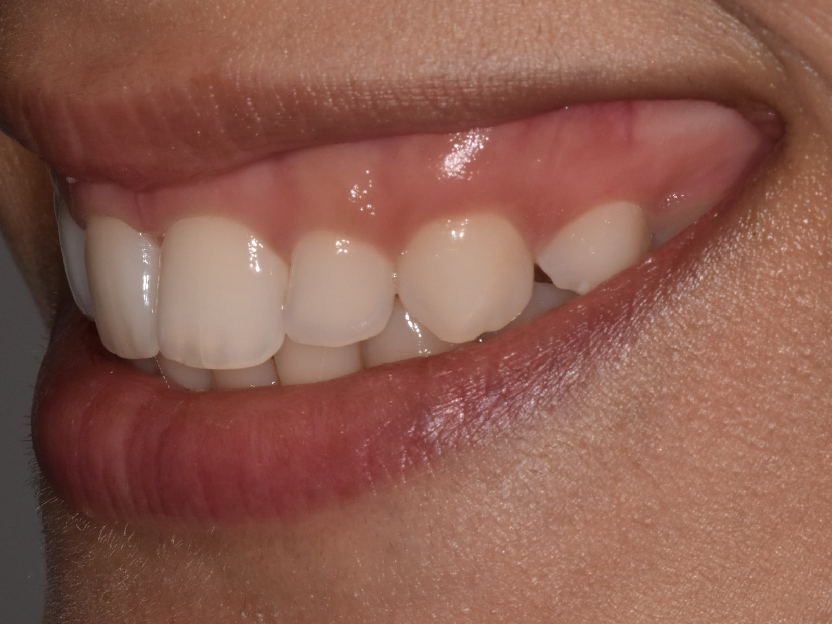 Gum contouring, before treatment, right side view of smile
