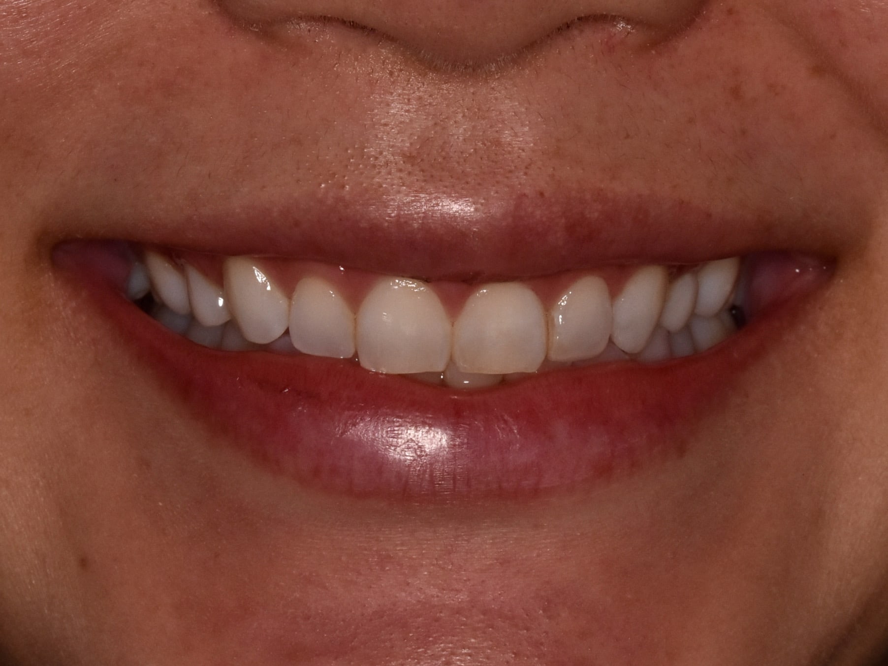Gum contouring and composite bonding, before treatment, front view of smile