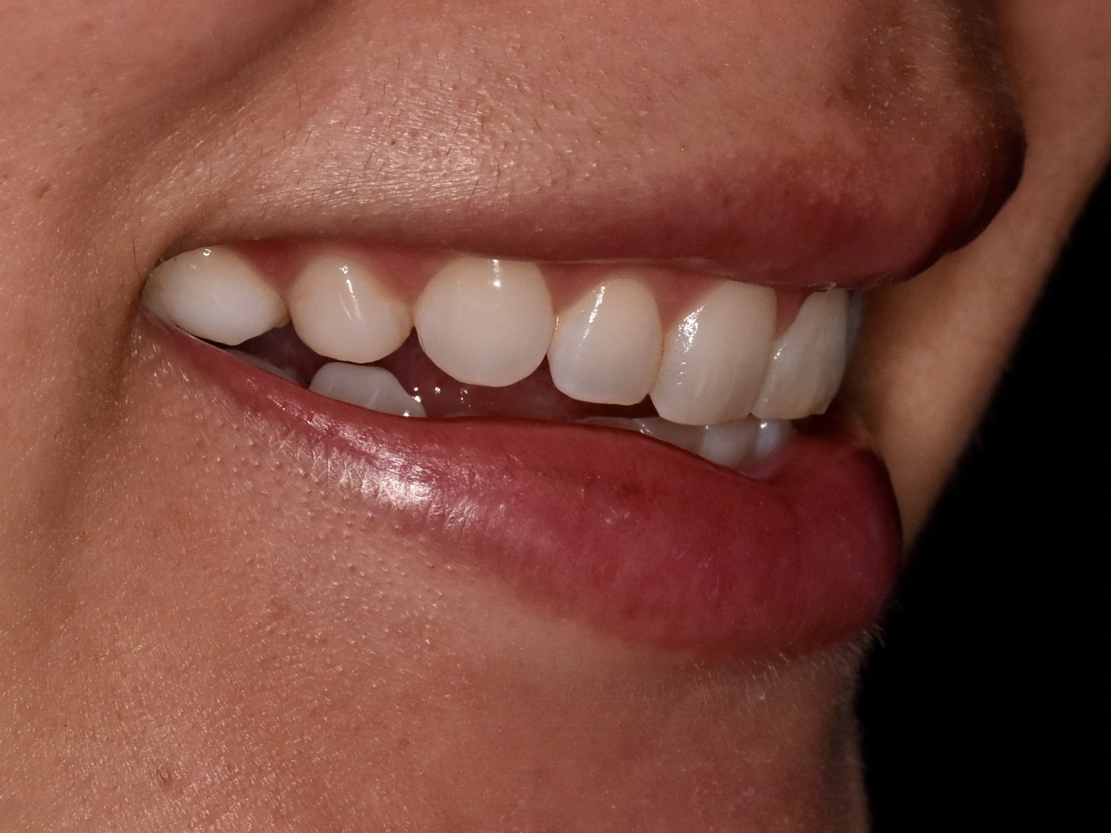Gum contouring and composite bonding, before treatment, left side view of smile