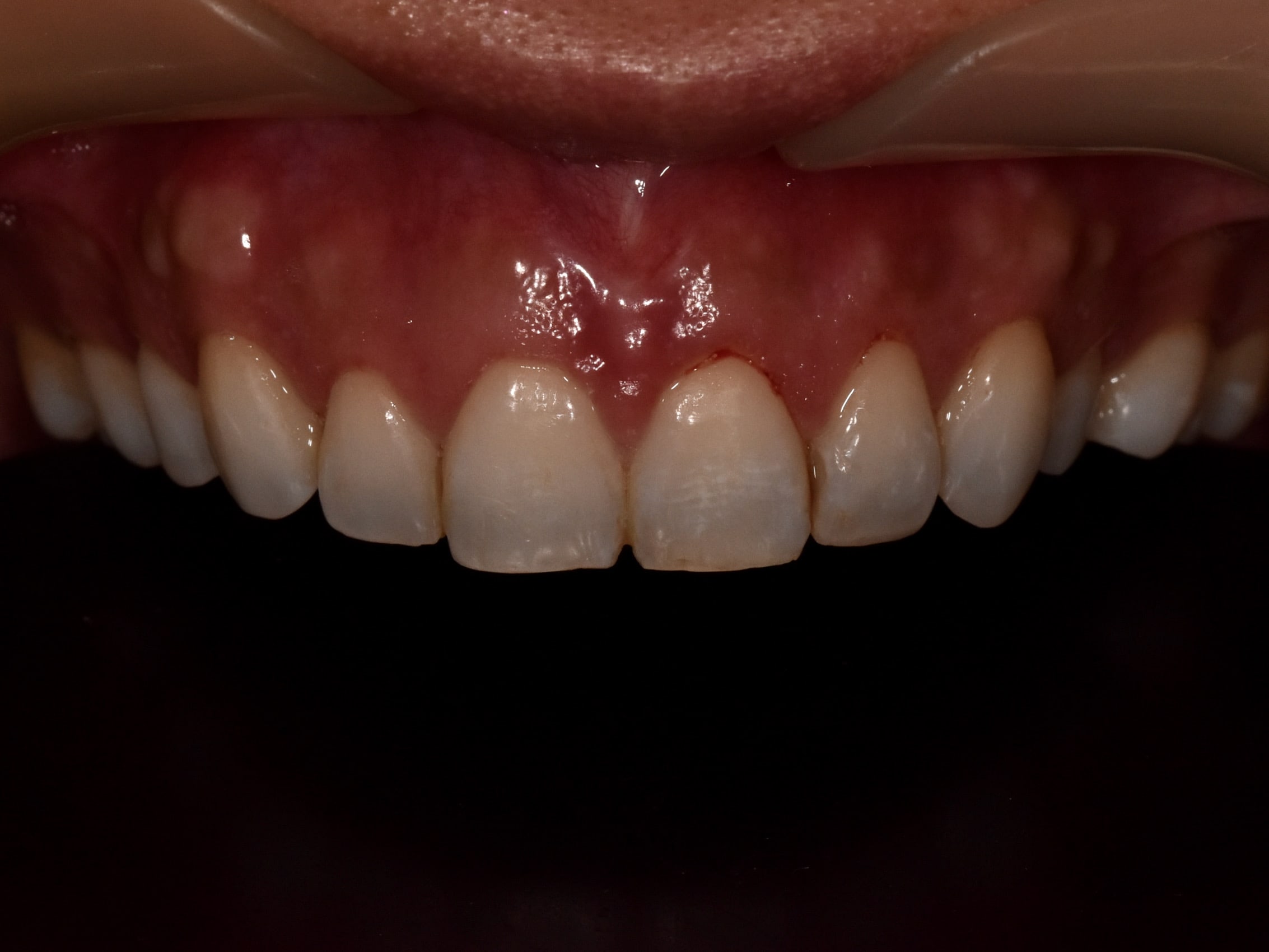Gum contouring and composite bonding, before treatment, close-up of teeth and gums