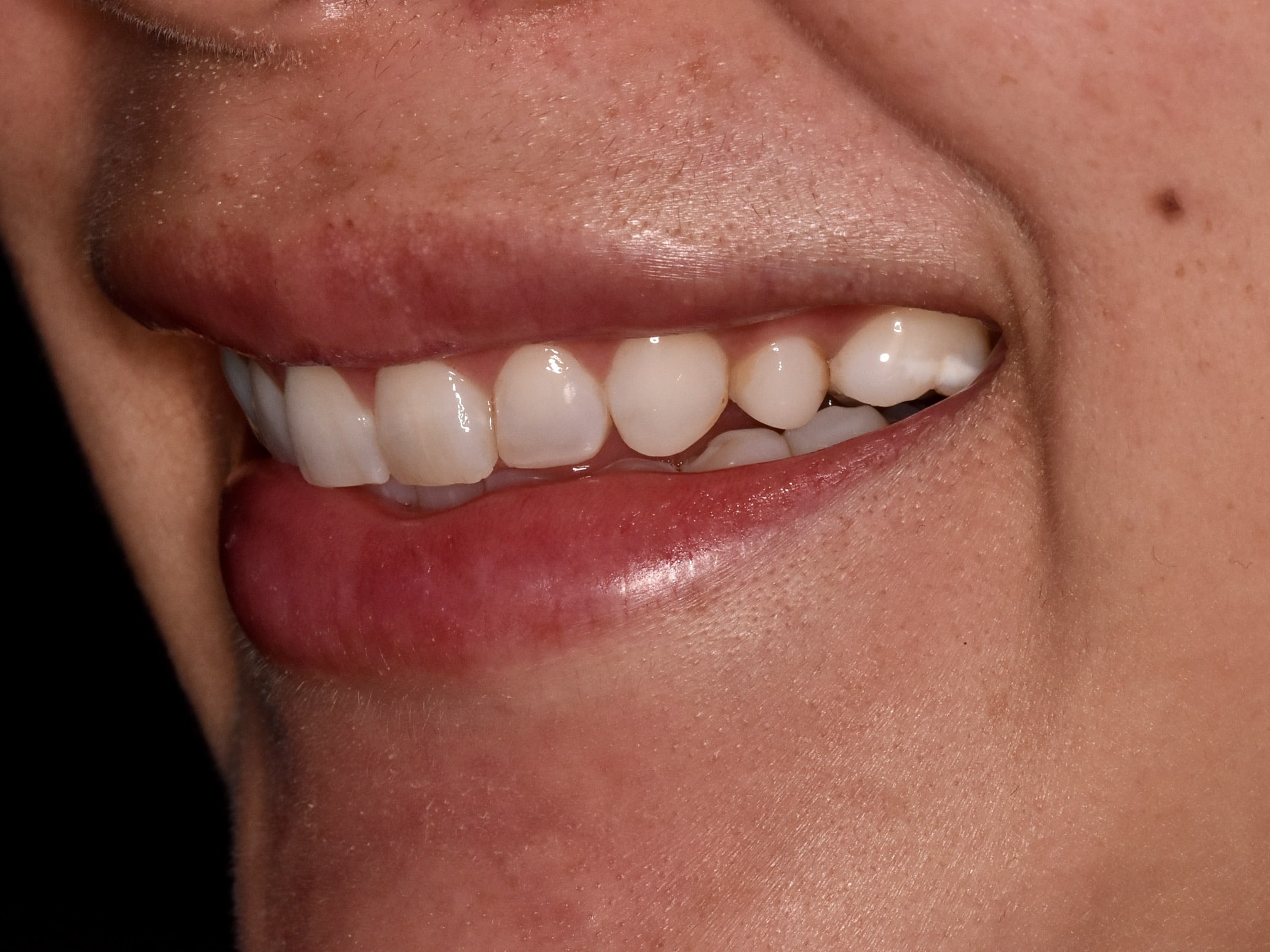 Gum contouring and composite bonding, before treatment, right side view of smile