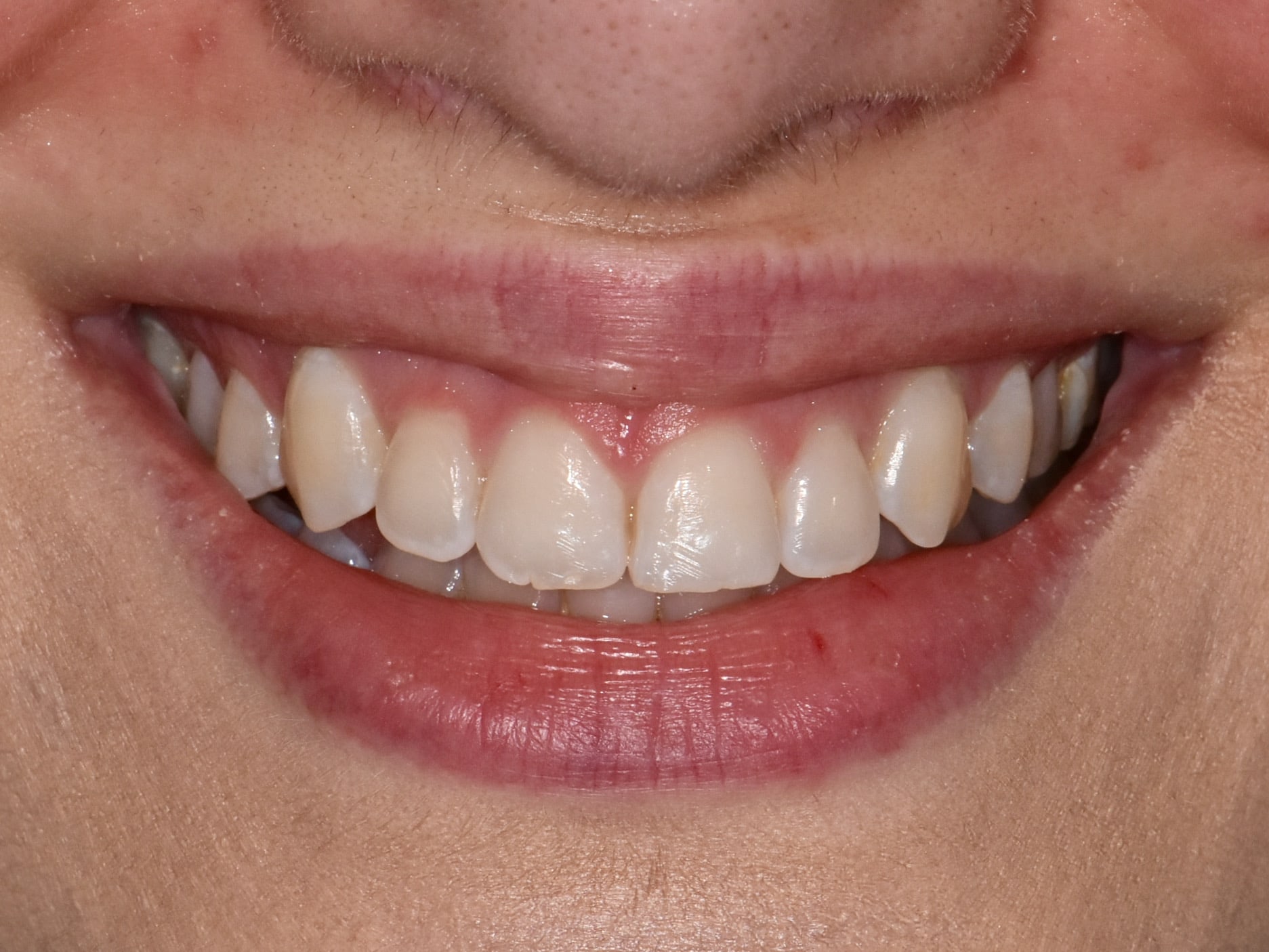 Gum contouring and composite bonding on 10 teeth, before treatment, front view of smile