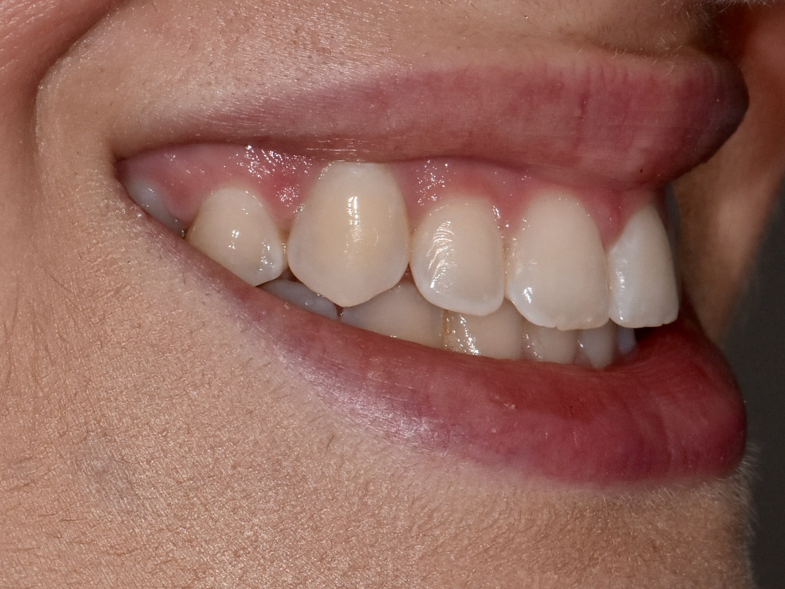 Gum contouring and composite bonding on 10 teeth, before treatment, left side view of smile