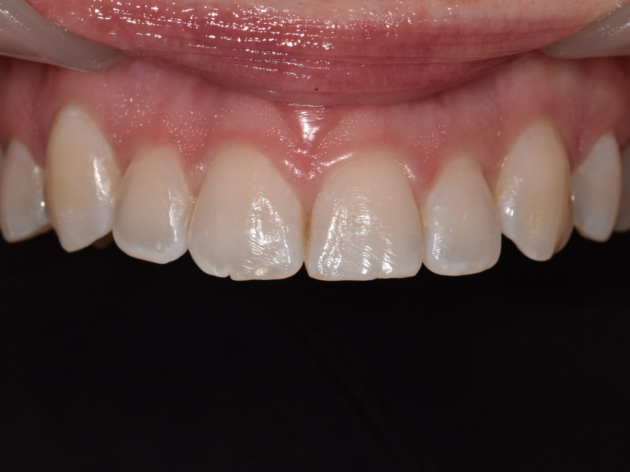 Gum contouring and composite bonding on 10 teeth, before treatment, close-up of teeth and gums