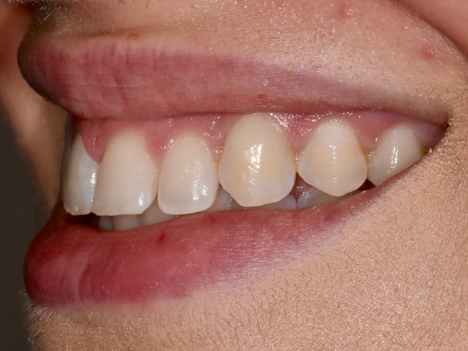 Gum contouring and composite bonding on 10 teeth, before treatment, right side view of smile