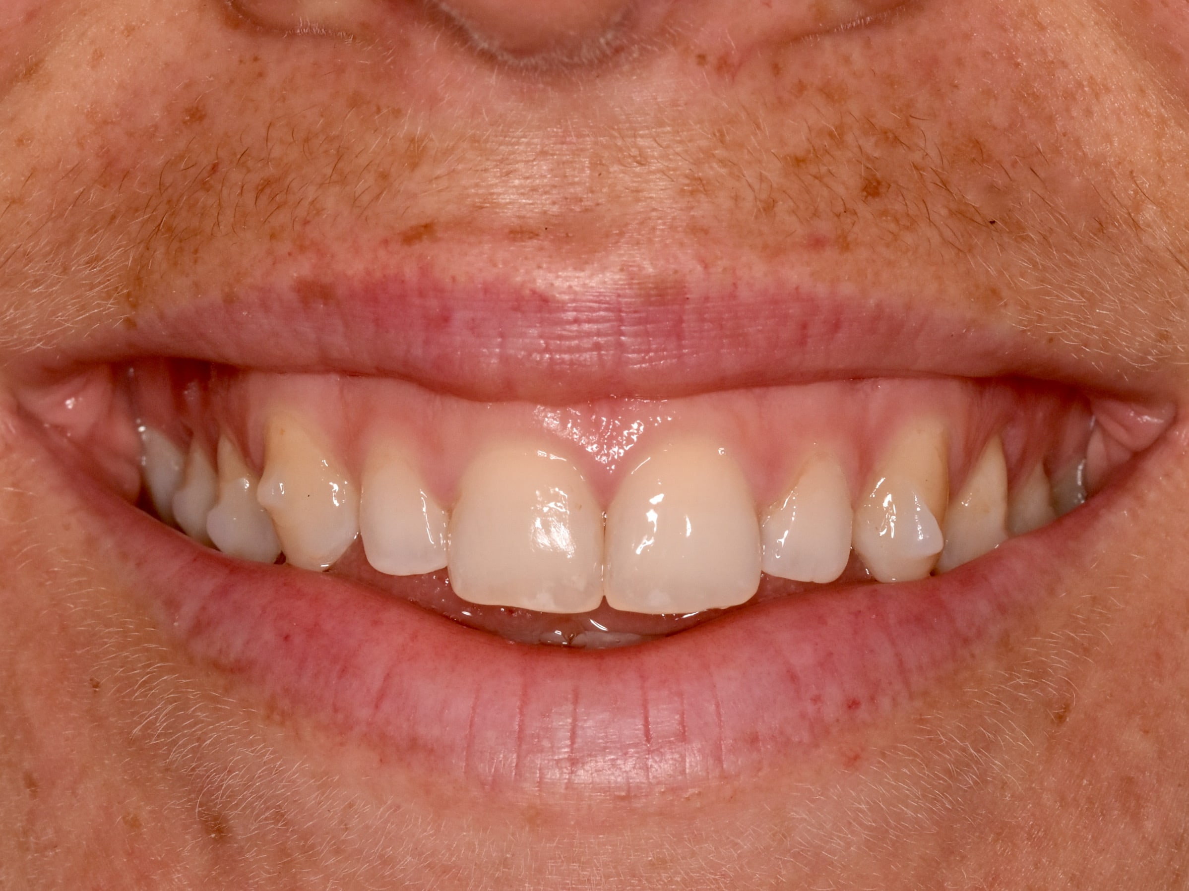 Gum contouring, before treatment, front view of smile