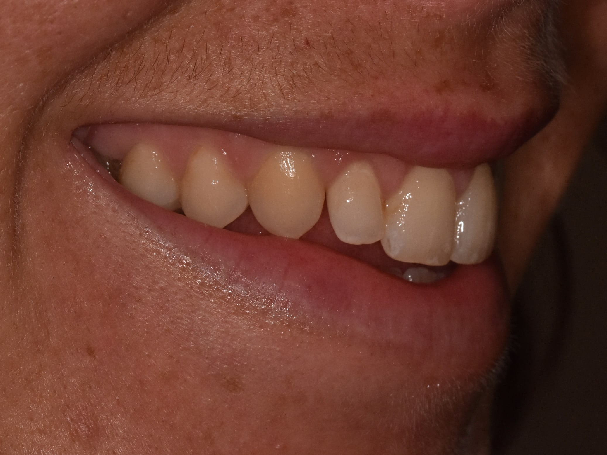 Gum contouring, before treatment, left side view of smile