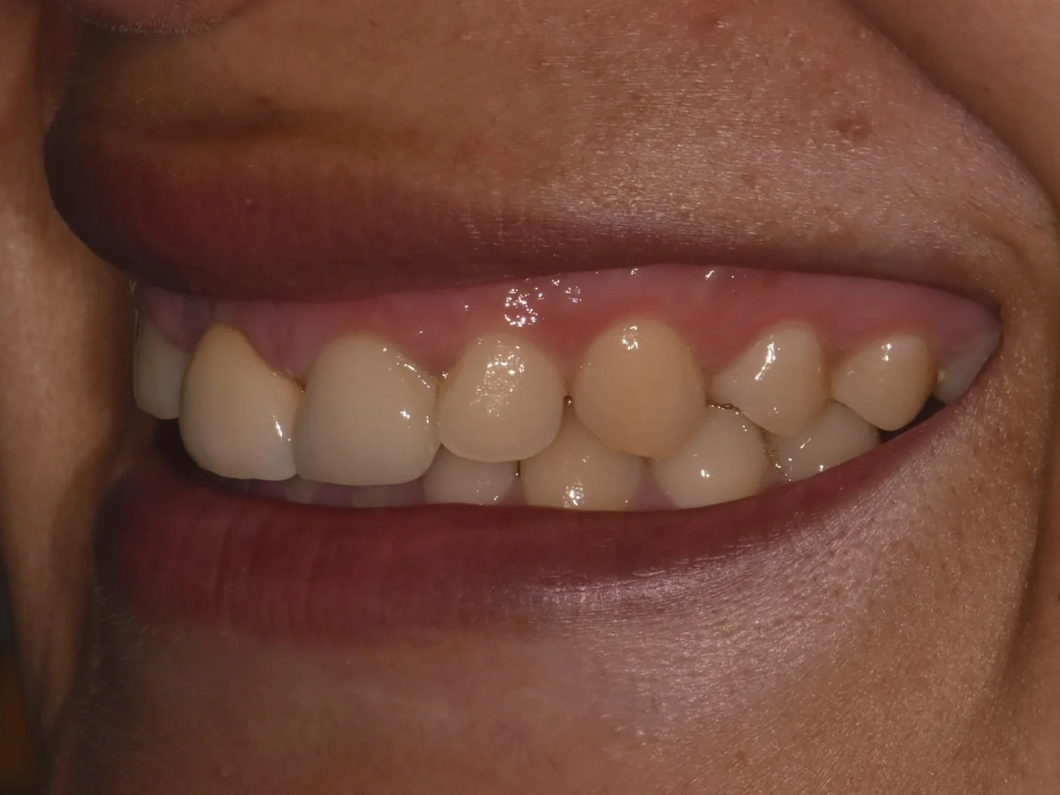Gum contouring, 1 implant and 1 dental crown, before treatment, left side view of smile
