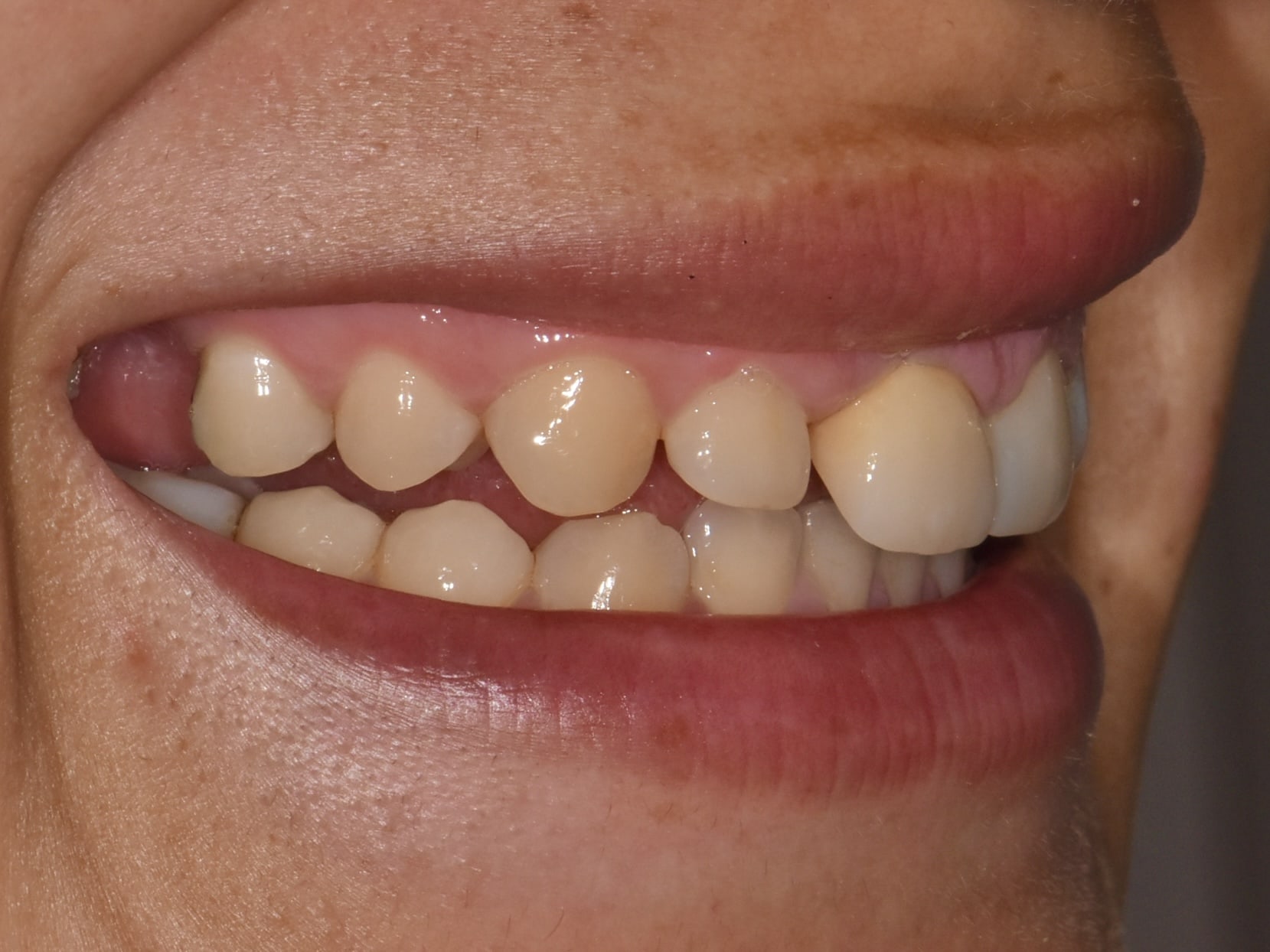 Gum contouring, 1 implant and 1 dental crown, before treatment, right side view of smile