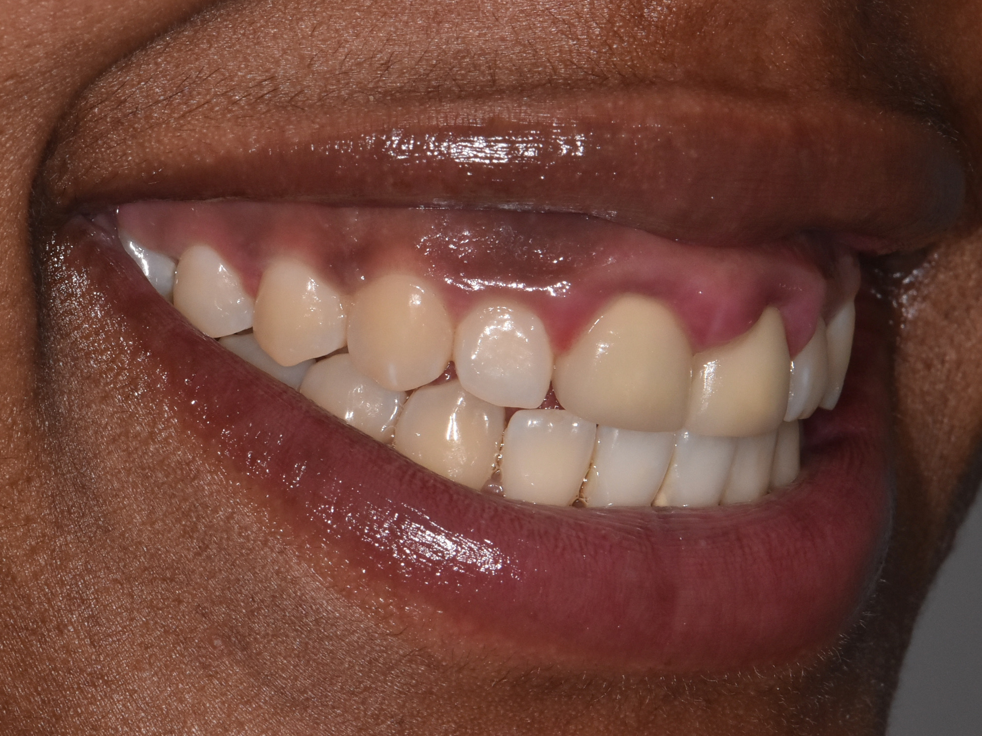 Gum contouring and replacement of 2 dental crowns, before treatment, left side view of smile