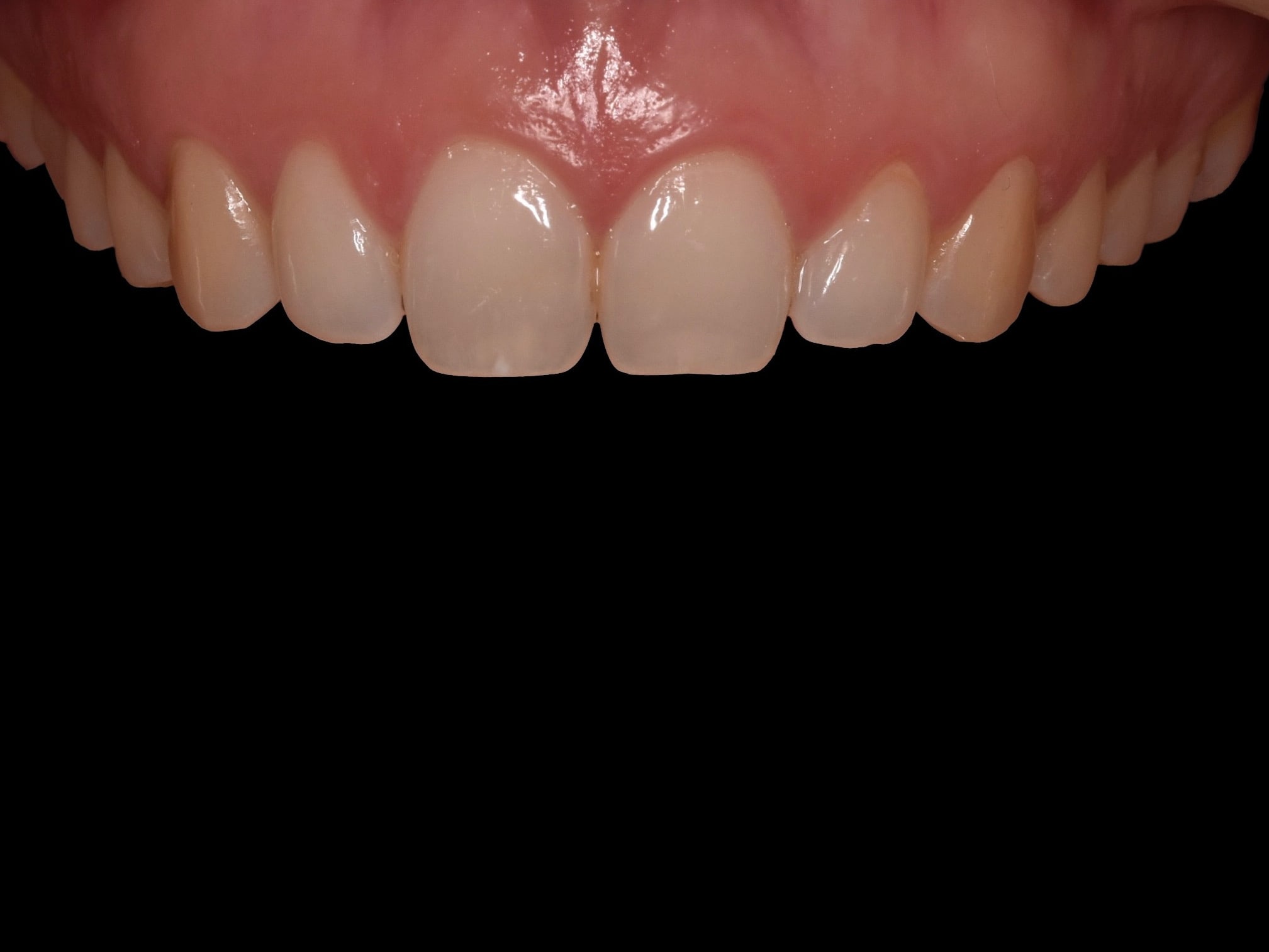 Gum contouring, before treatment, close-up of teeth and gums