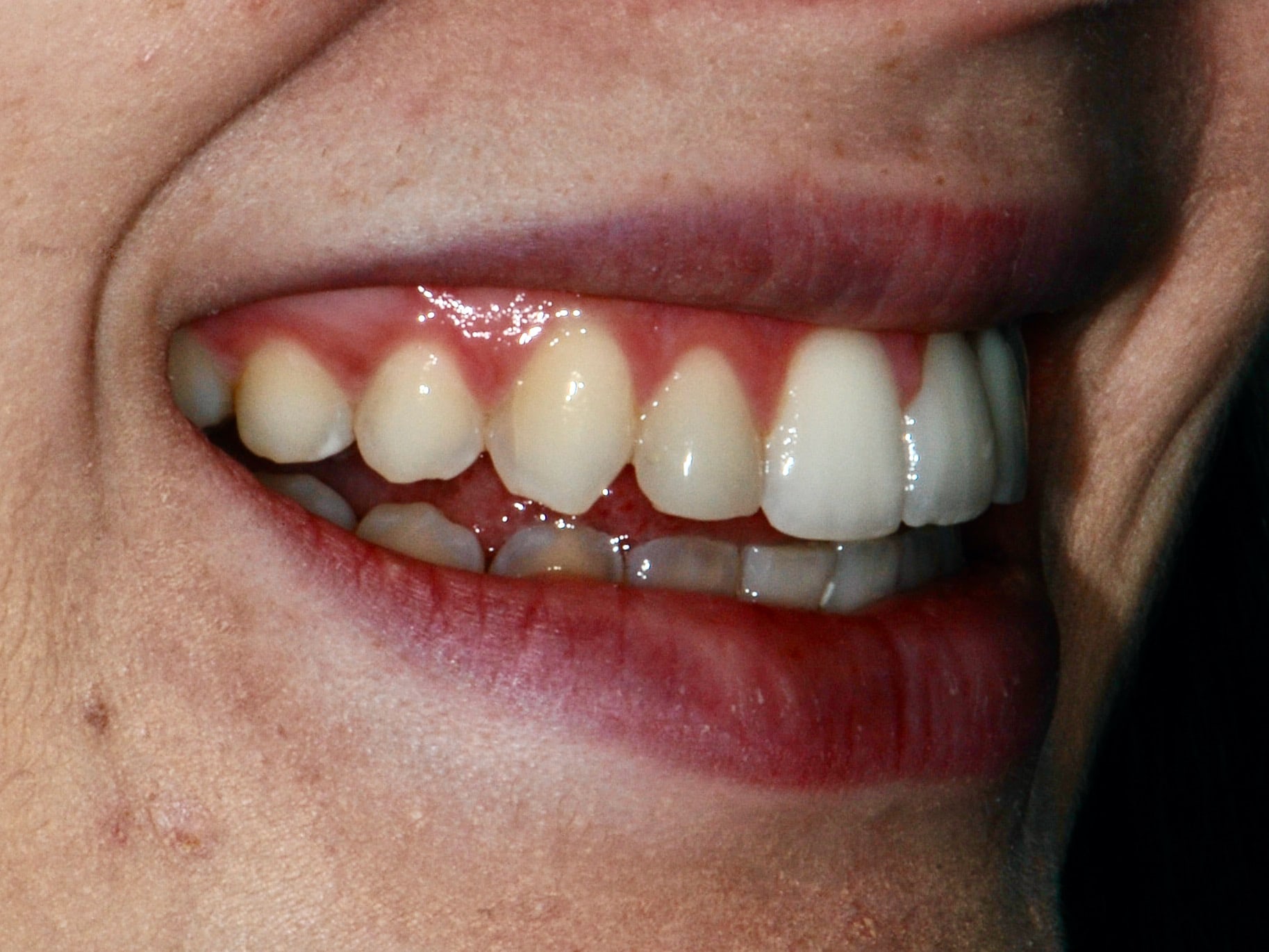 Single implant and gum contouring, after treatment, left side view of smile