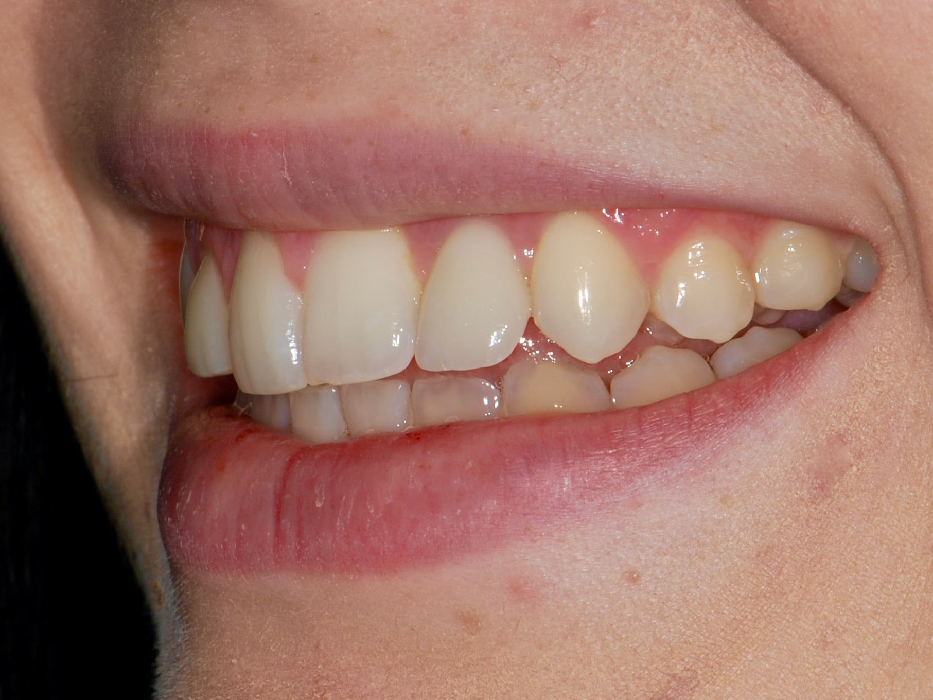 Single implant and gum contouring, after treatment, right side view of smile