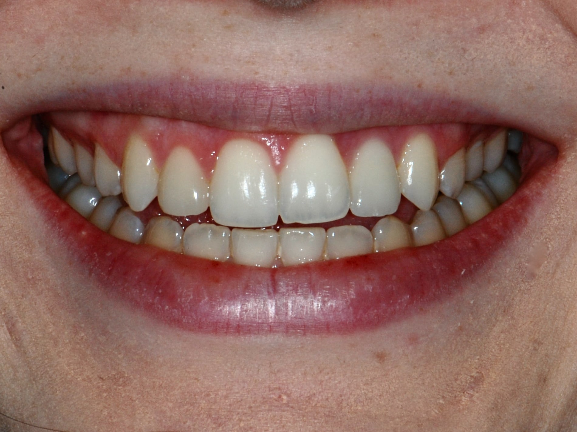 Single implant and gum contouring, after treatment, front view of smile