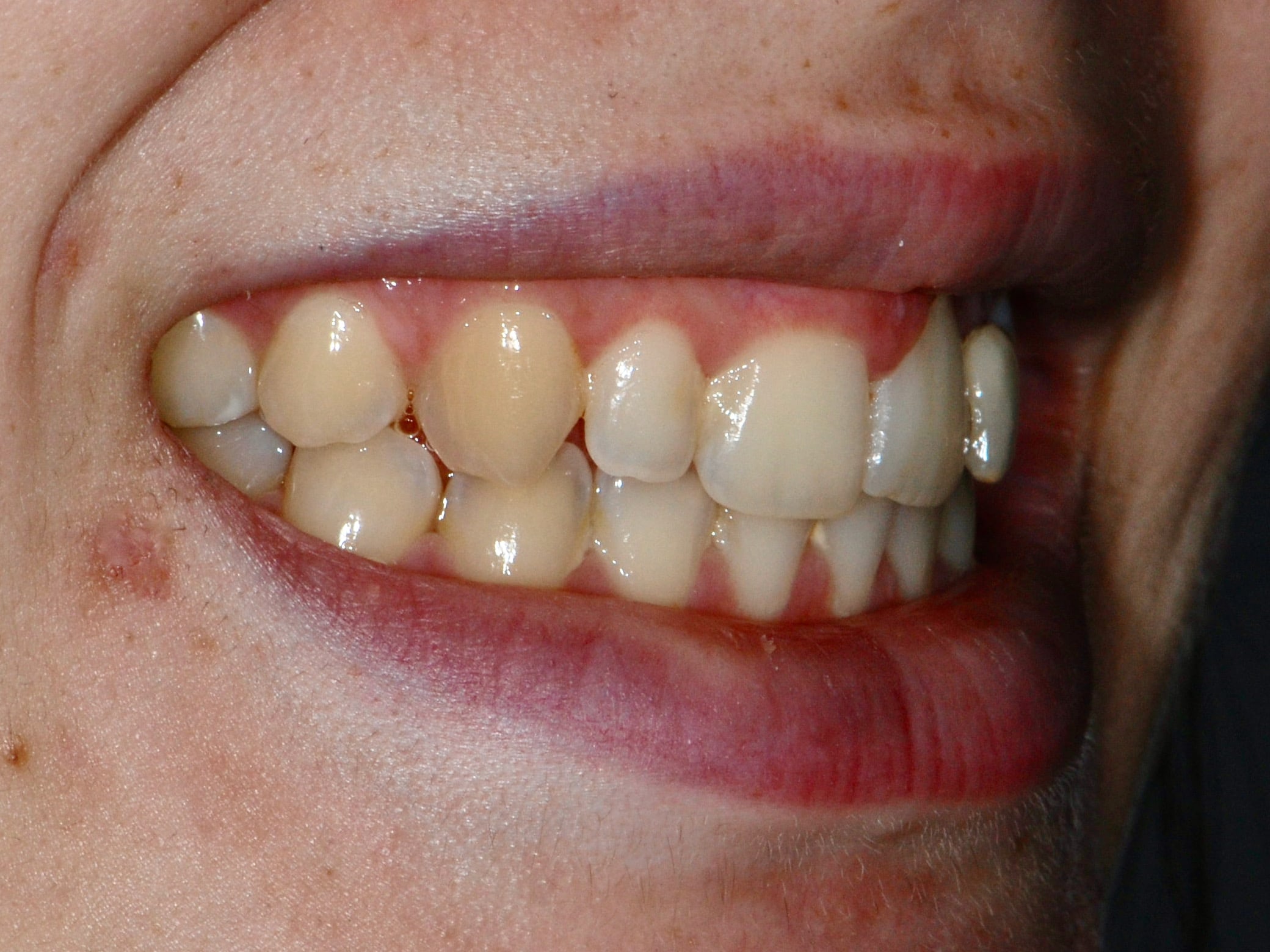 Single implant and gum contouring, before treatment, left side view of smile