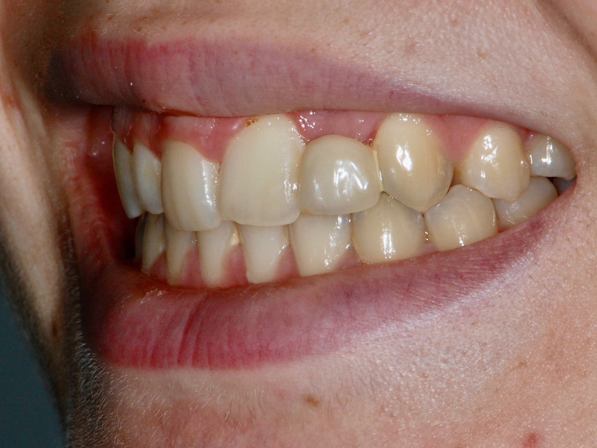 Single implant and gum contouring, before treatment, right side view of smile