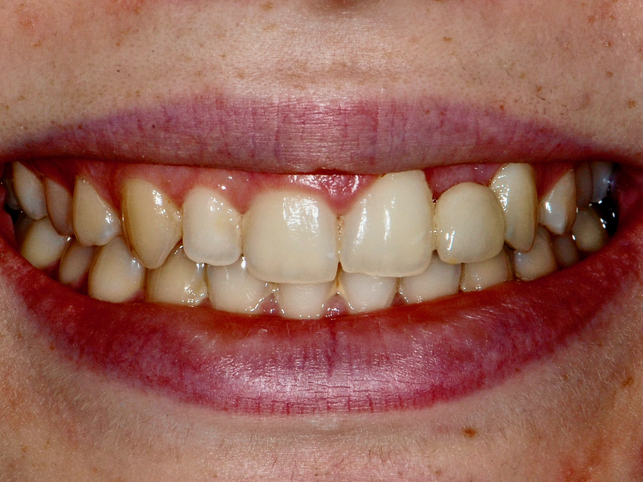 Single implant and gum contouring, before treatment, front view of smile