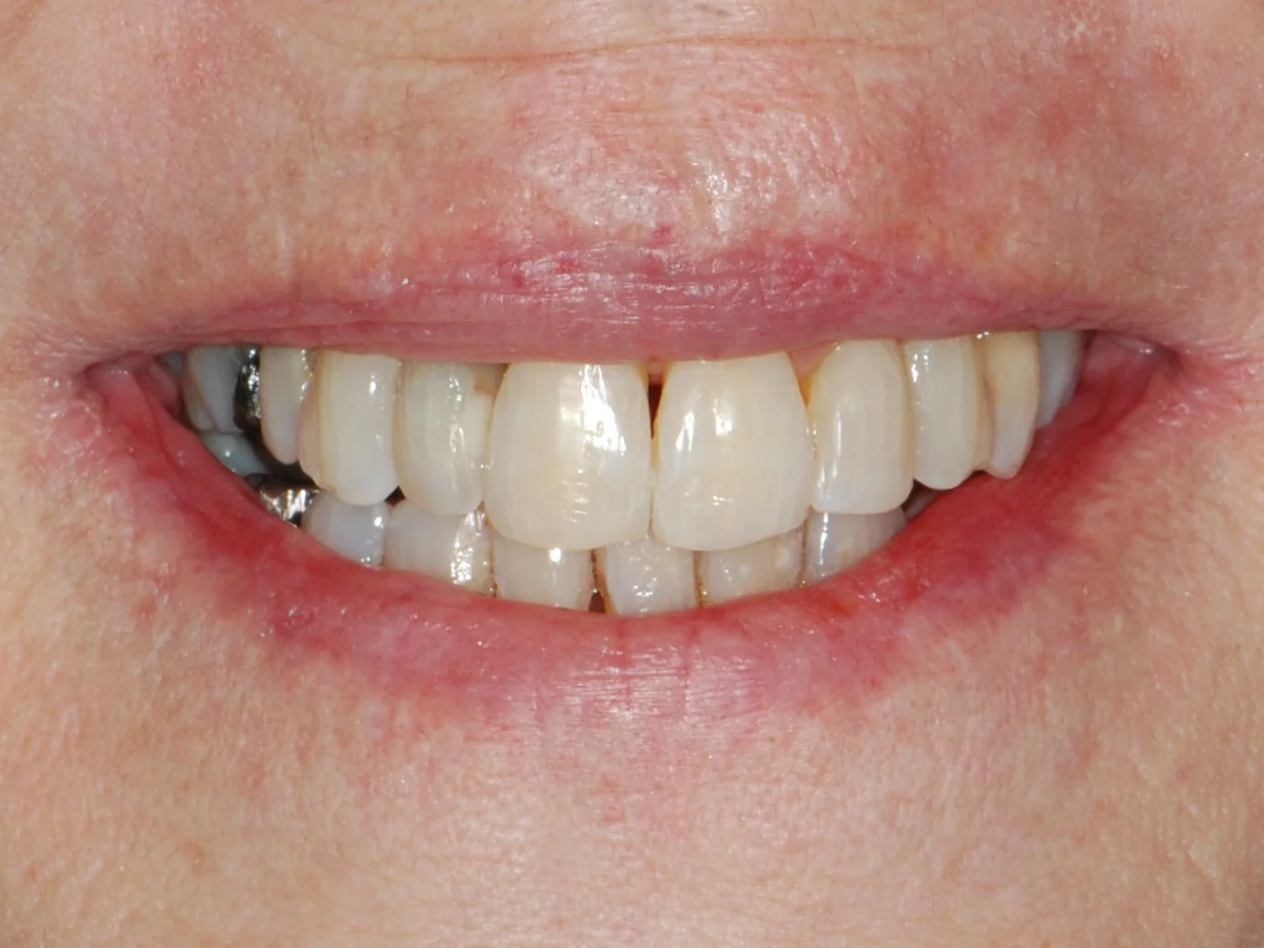 Invisalign (10 months), after treatment, front view of smile