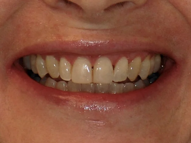 Invisalign (18 months), after treatment, front view of smile