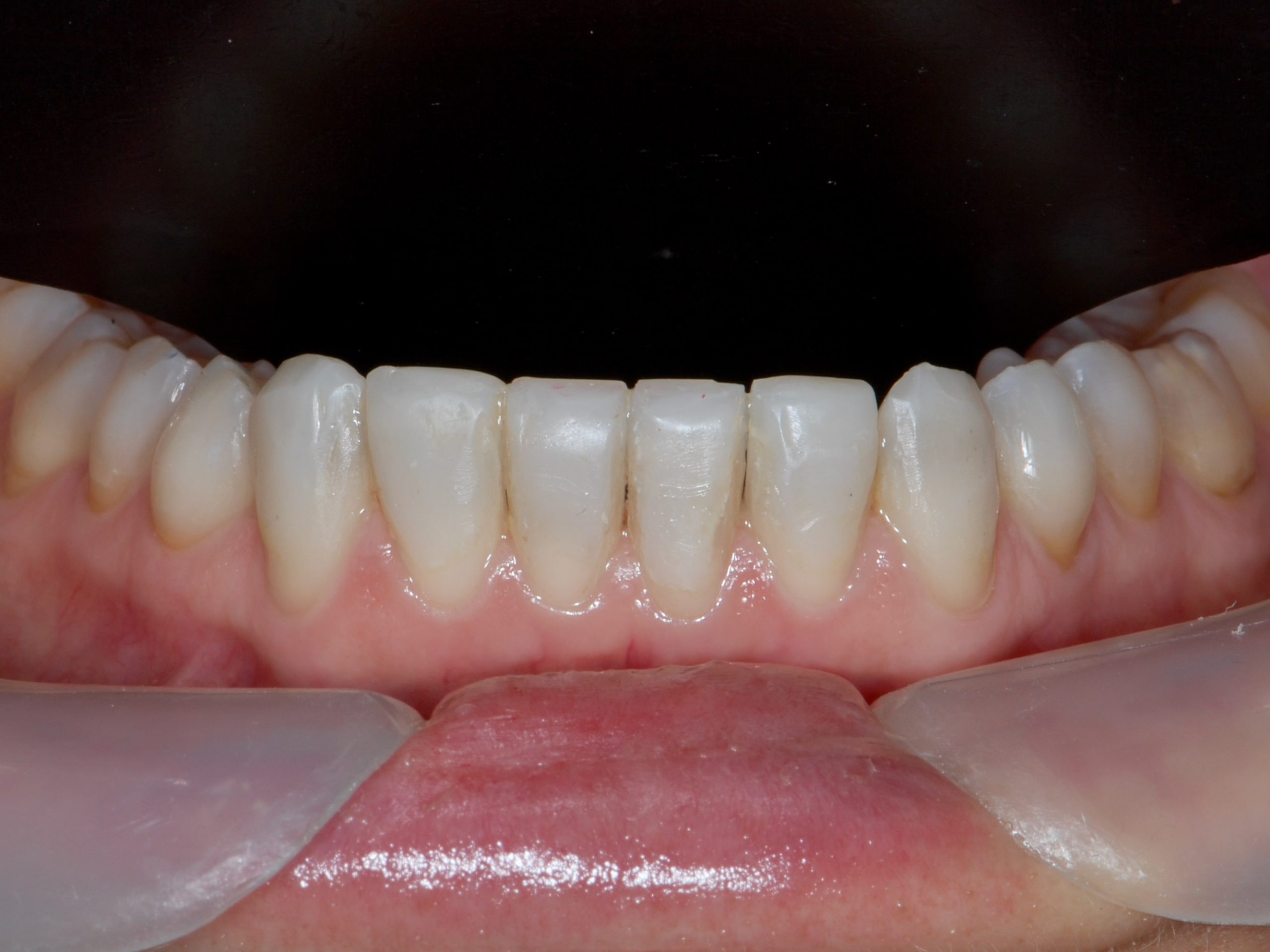 Invisalign and composite bonding (9 months), after treatment, close-up of the lower teeth
