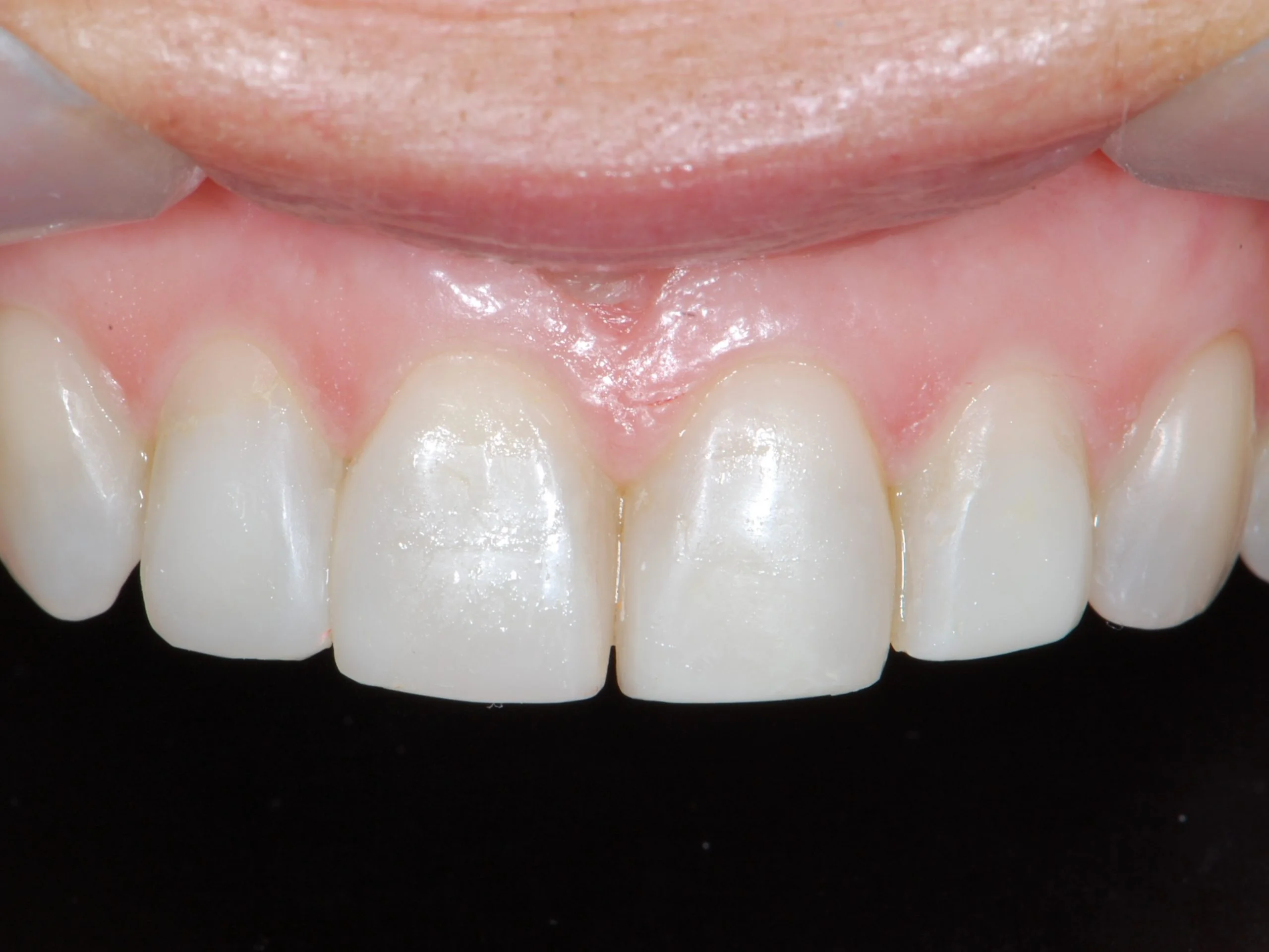 Invisalign and composite bonding (9 months), after treatment, close-up of the upper teeth