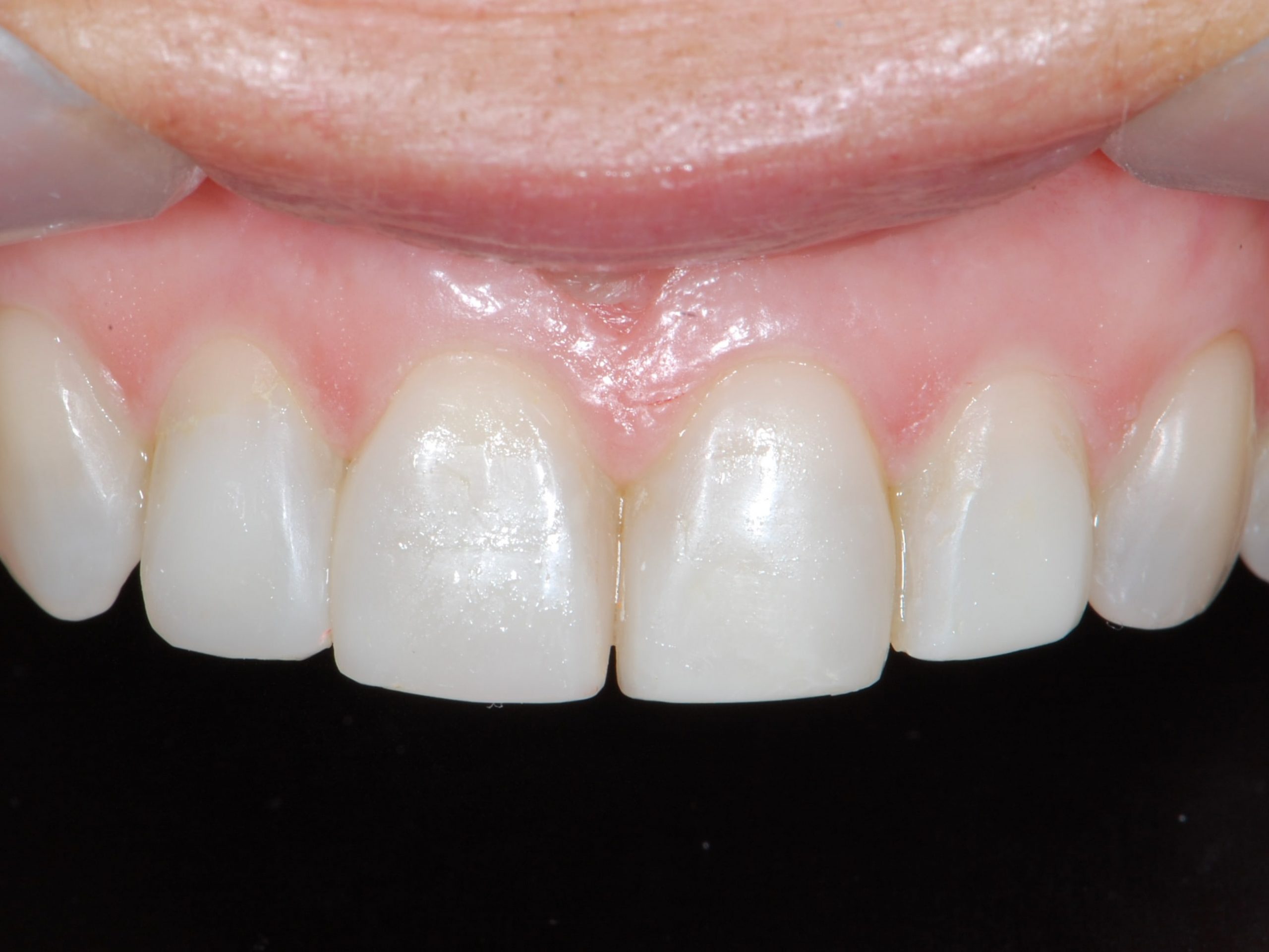Invisalign and composite bonding (9 months), after treatment, close-up of the upper teeth
