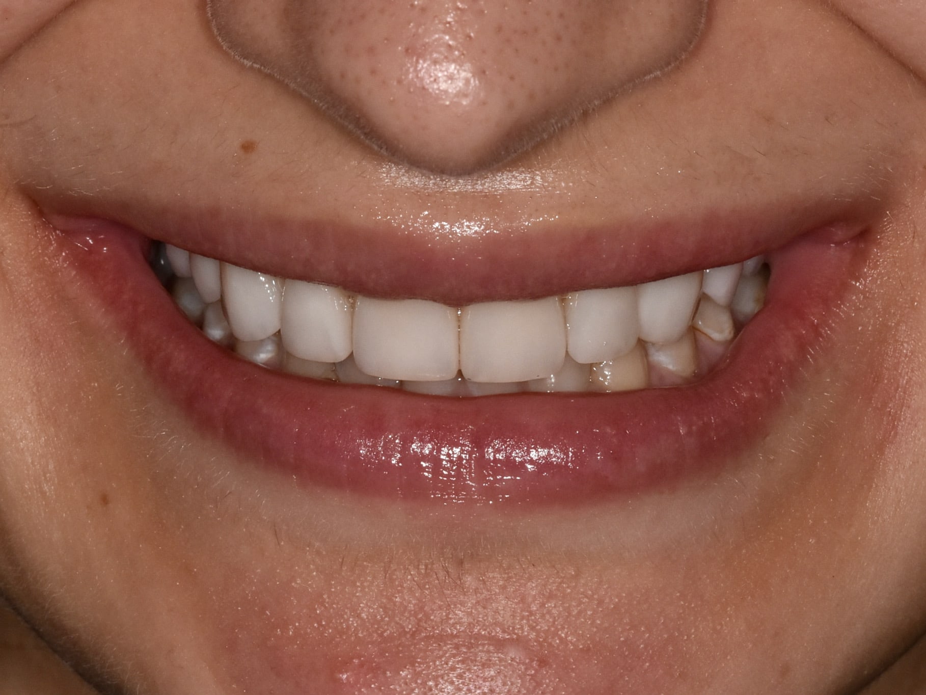 Invisalign, gum contouring and 10 porcelain veneers, after treatment, front view of smile