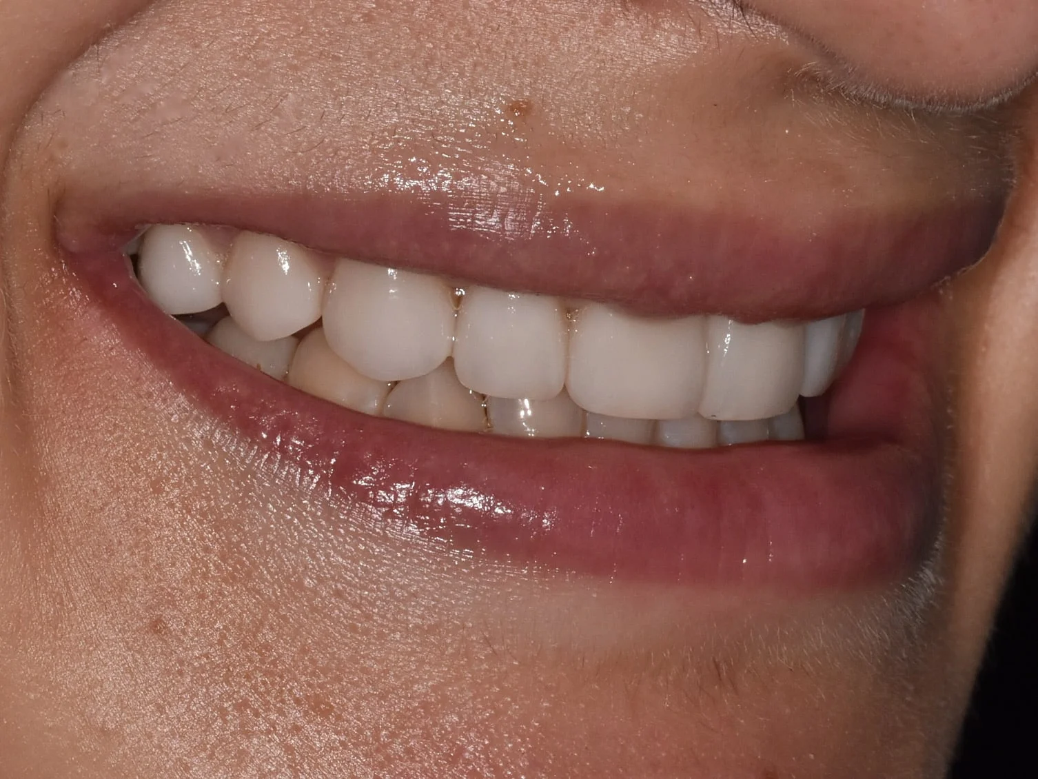 Invisalign, gum contouring and 10 porcelain veneers, after treatment, left side view of smile