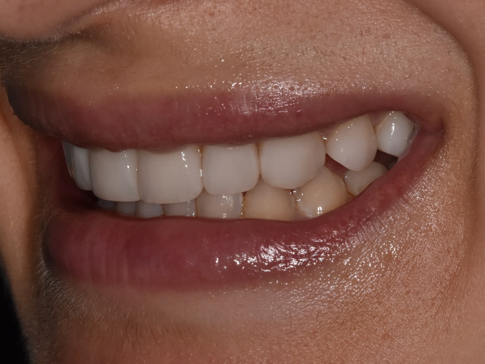 Invisalign, gum contouring and 10 porcelain veneers, after treatment, right side view of smile