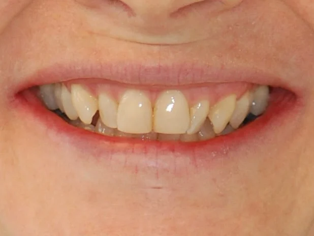 Invisalign (18 months), before treatment, front view of smile