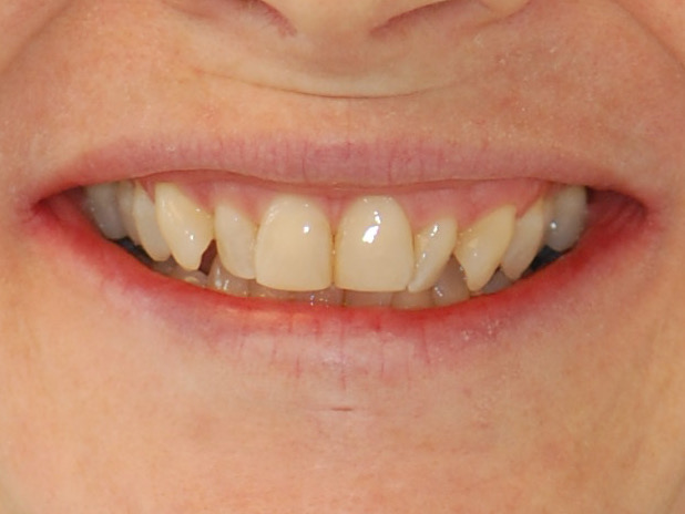Invisalign (18 months), before treatment, front view of smile