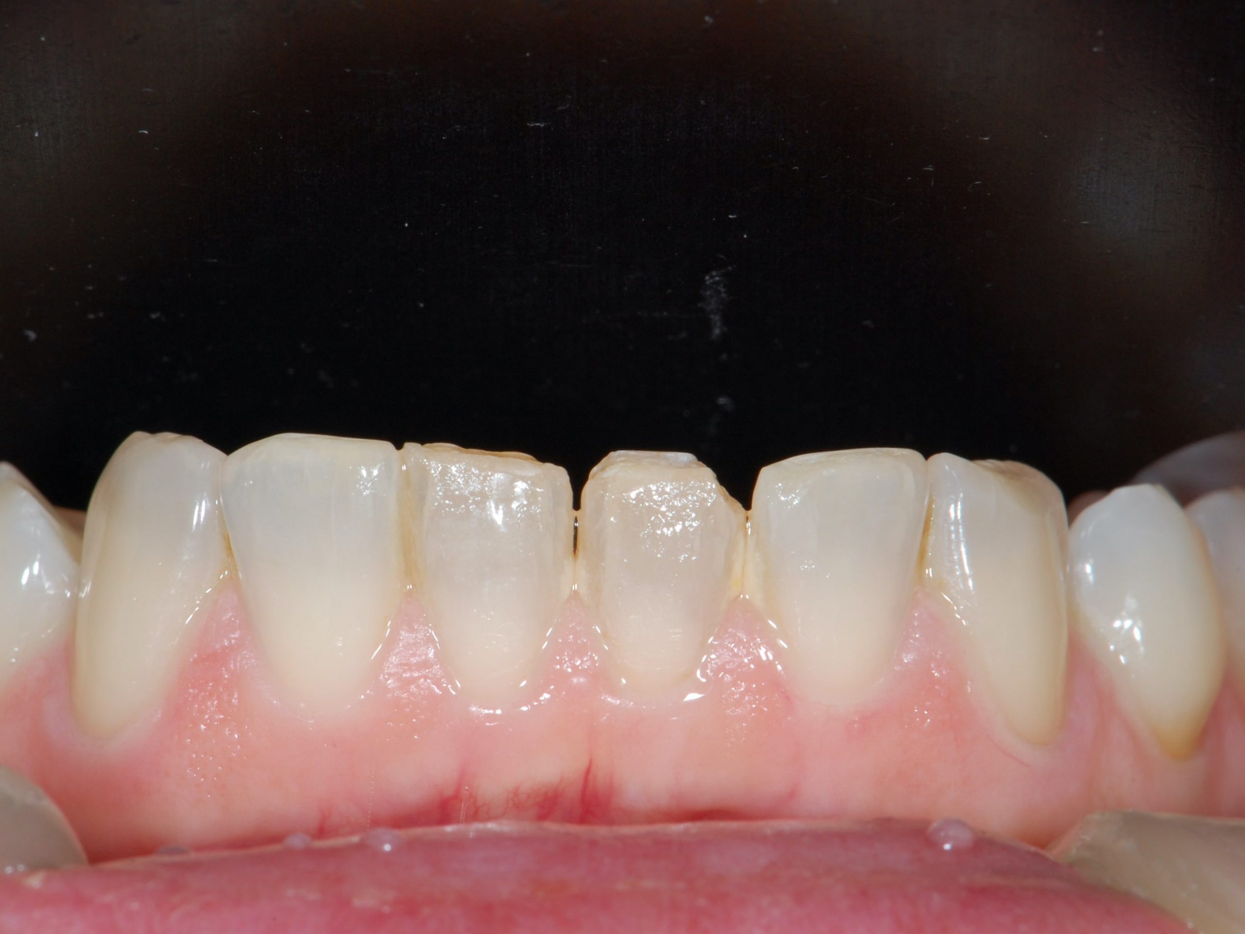 Invisalign and composite bonding (9 months), before treatment, close-up of the lower teeth