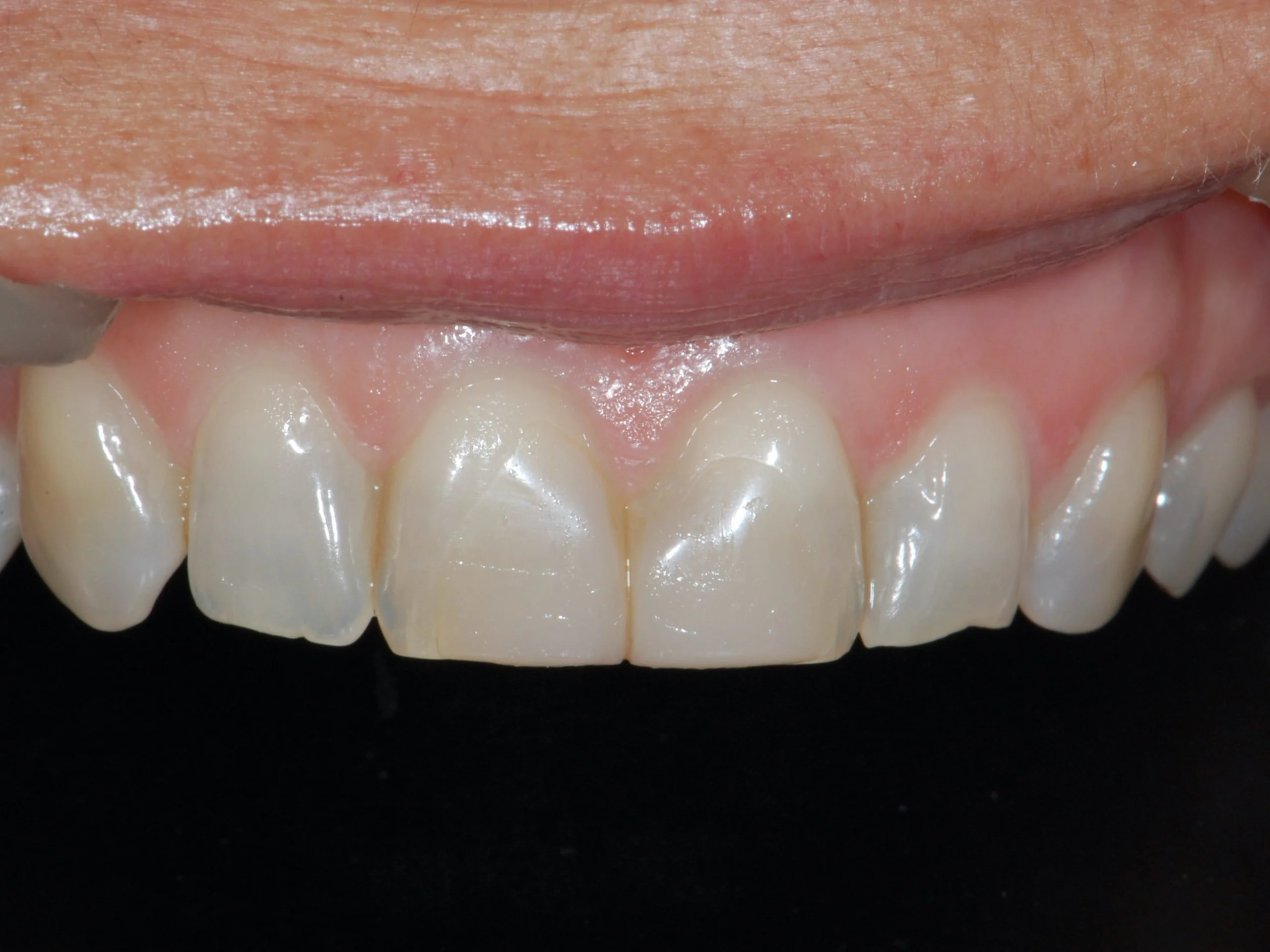 Invisalign and composite bonding (9 months), before treatment, close-up of the upper teeth