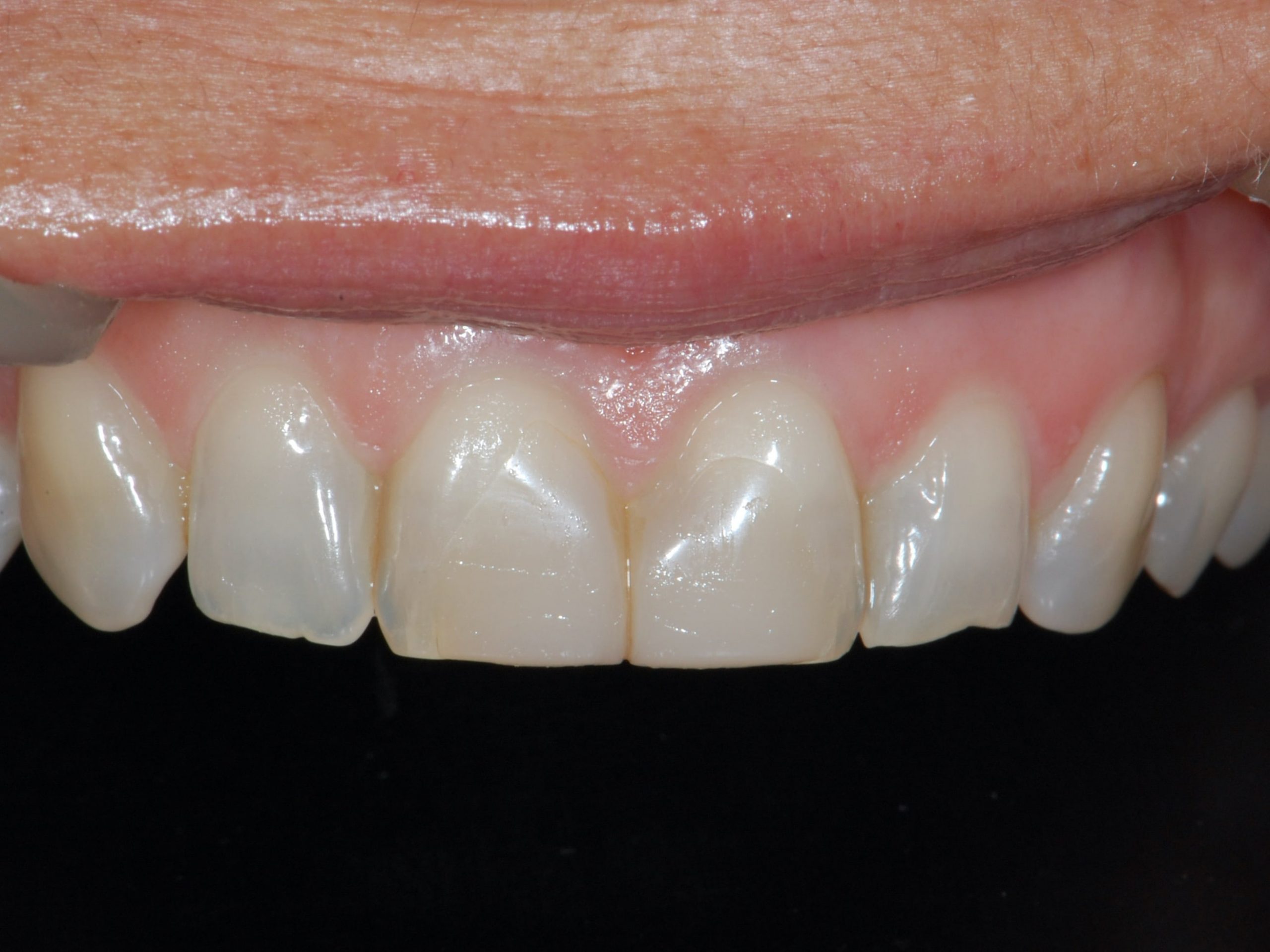 Invisalign and composite bonding (9 months), before treatment, close-up of the upper teeth