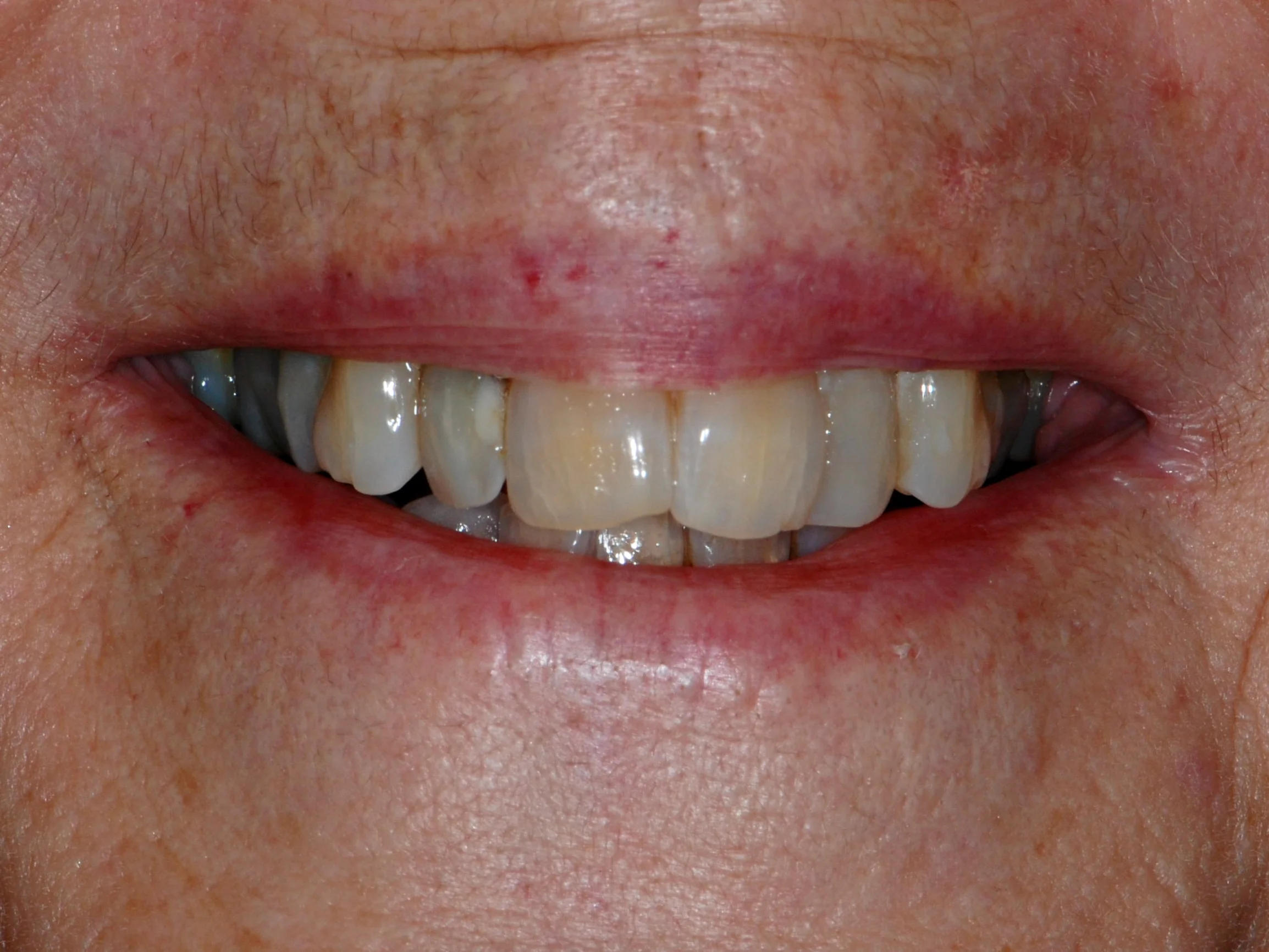 Invisalign (10 months), before treatment, front view of smile