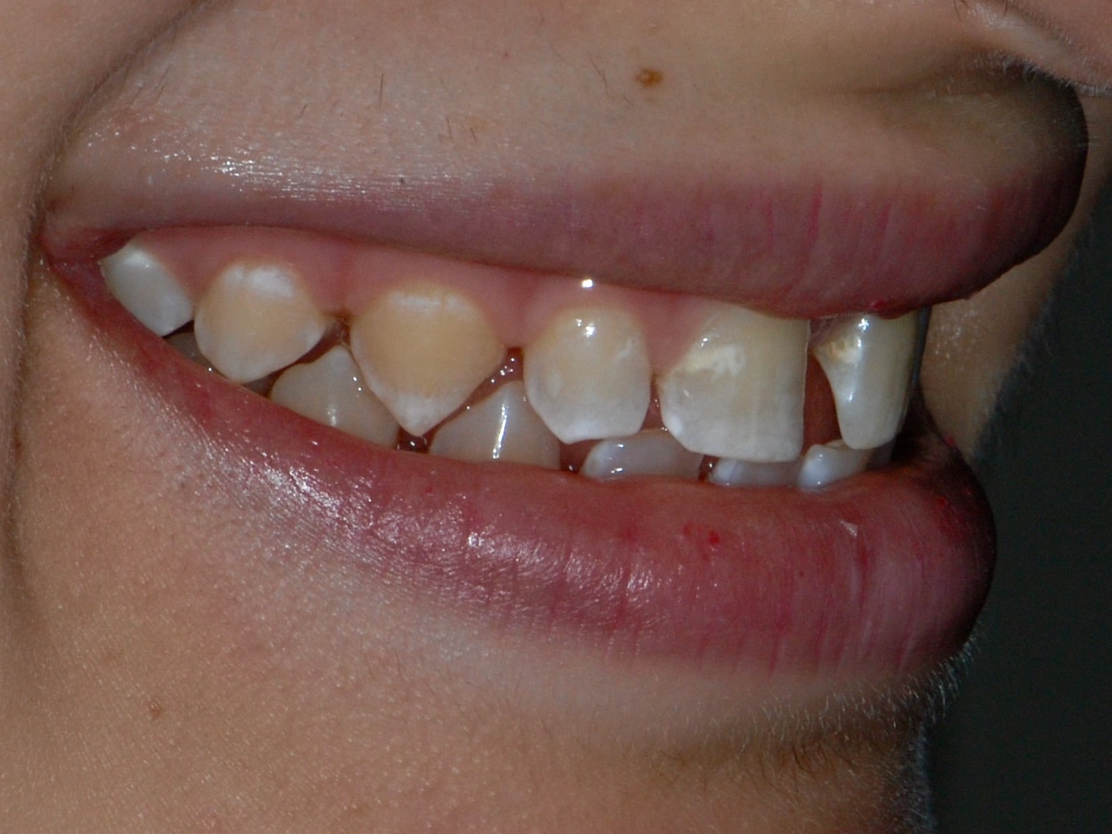 Invisalign, gum contouring and 10 porcelain veneers, before treatment, left side view of smile