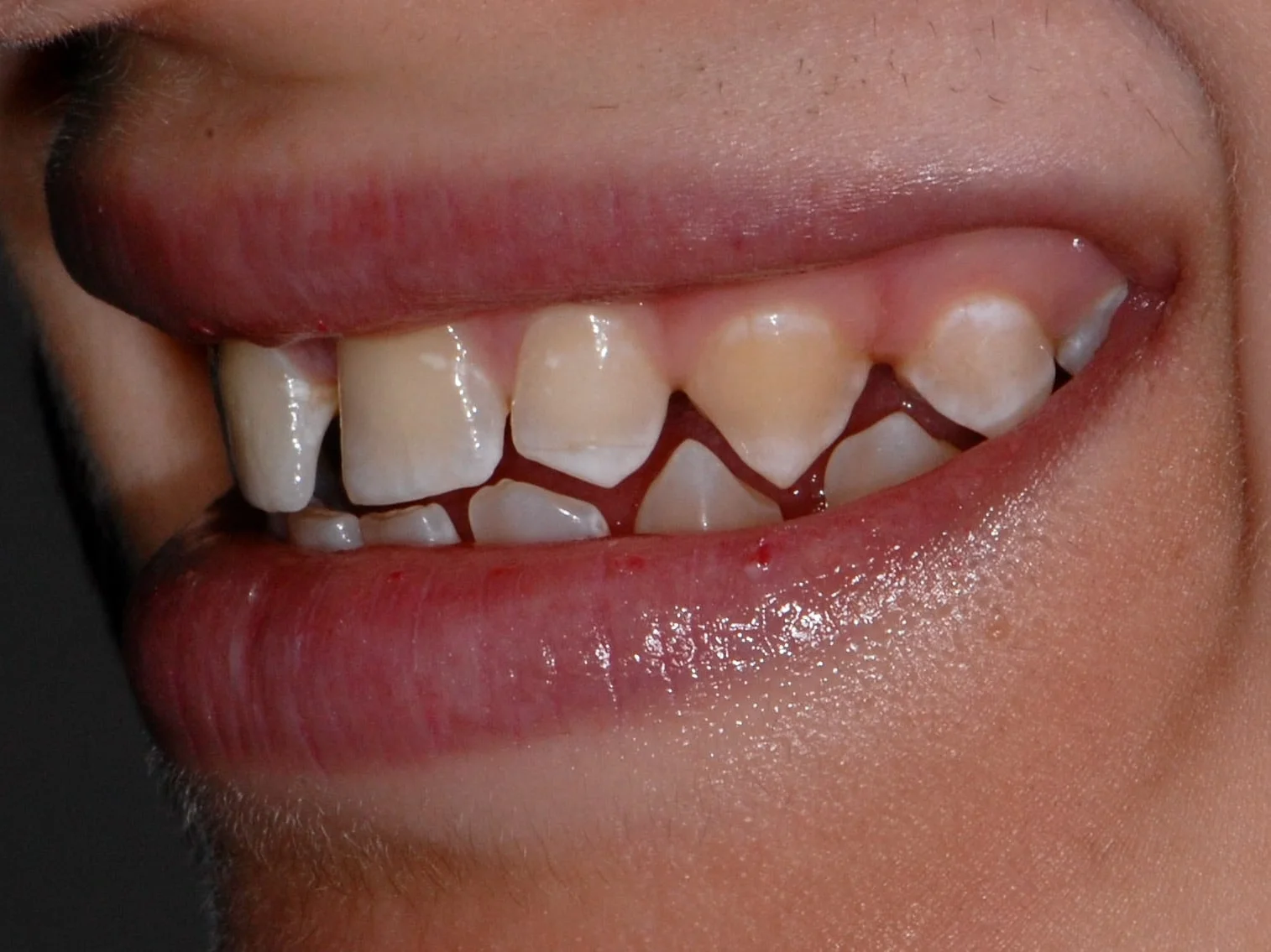 Invisalign, gum contouring and 10 porcelain veneers, before treatment, right side view of smile
