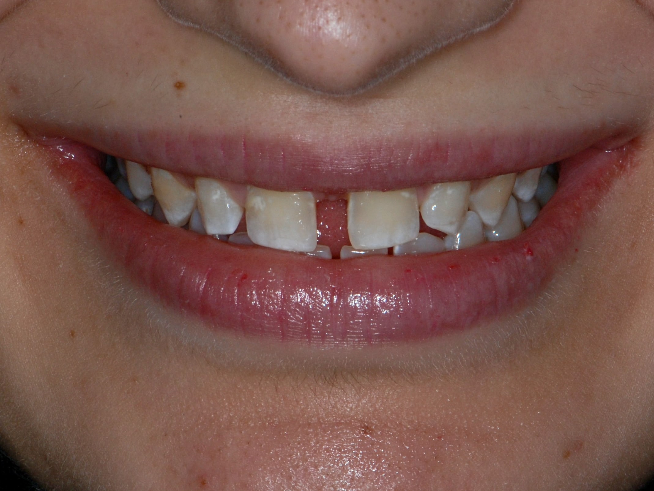 Invisalign, gum contouring and 10 porcelain veneers, before treatment, front view of smile