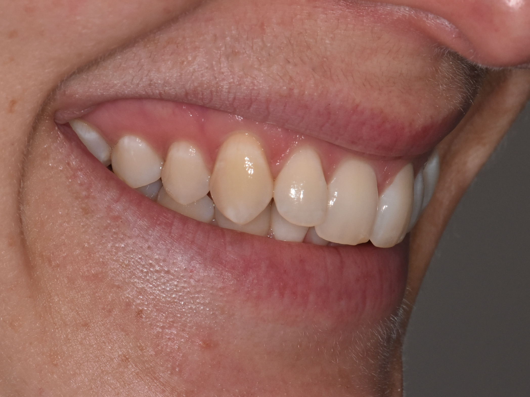 Invisalign (10 months), right side view of smile