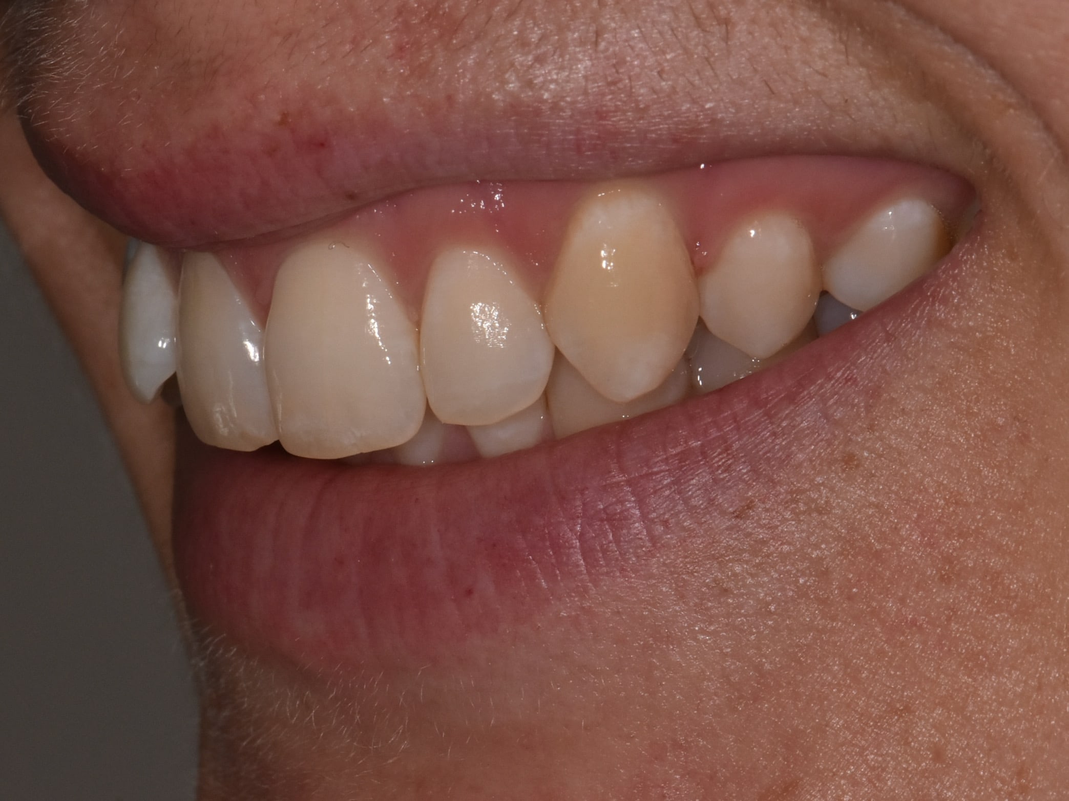 Invisalign (10 months), left side view of smile